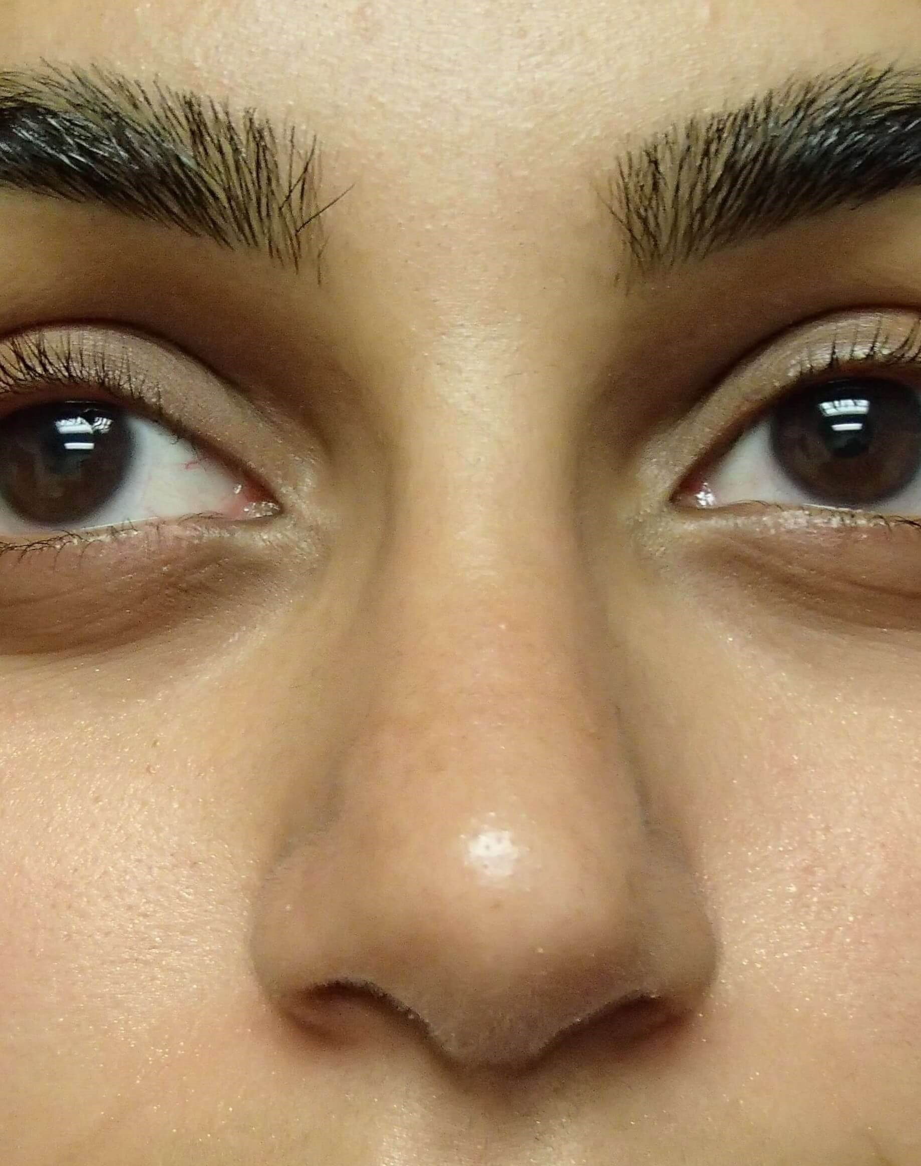 Rhinoplasty (nose job) After