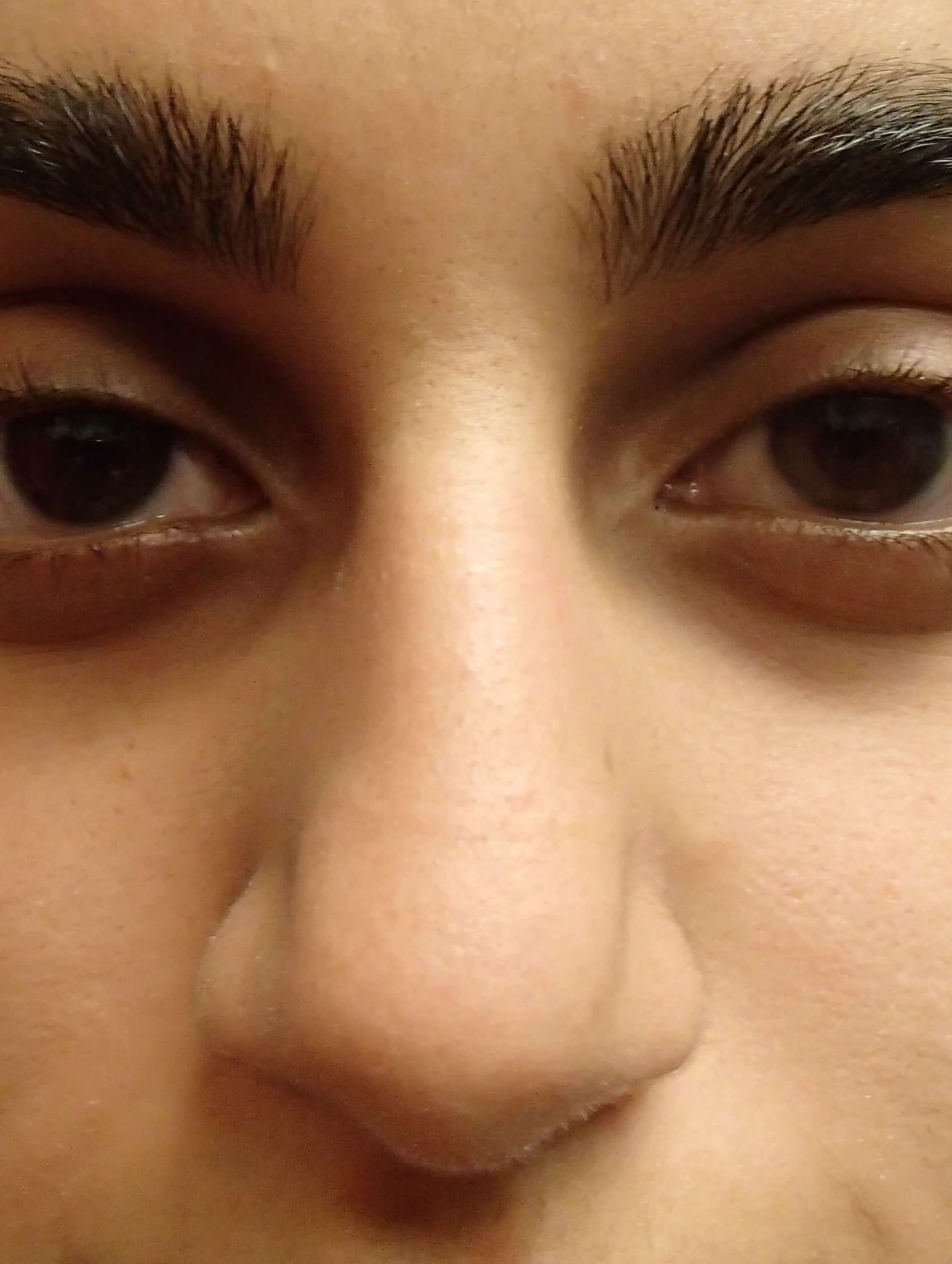 Rhinoplasty (nose job) Before