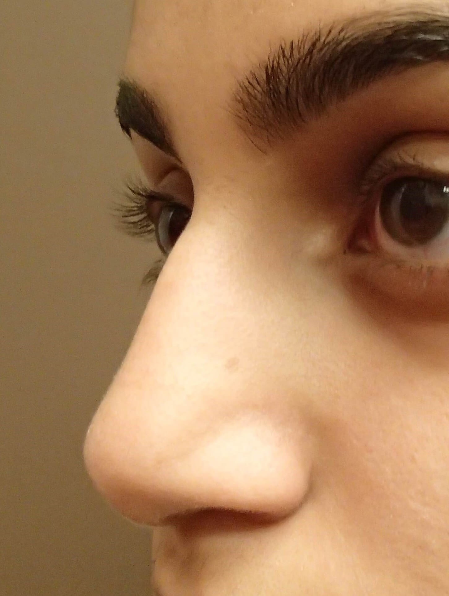 Rhinoplasty (nose job) Before