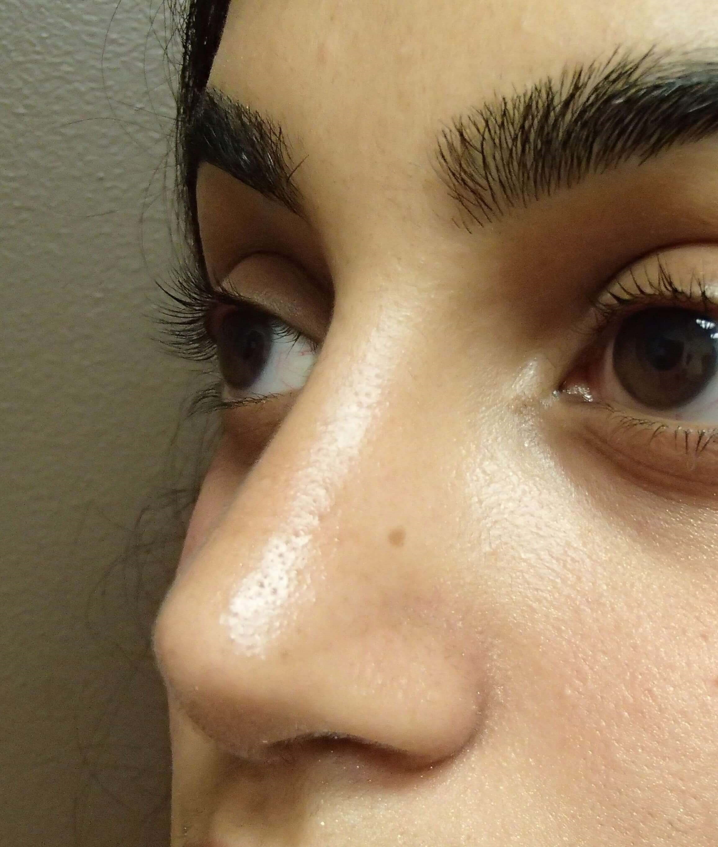 Rhinoplasty (nose job) After