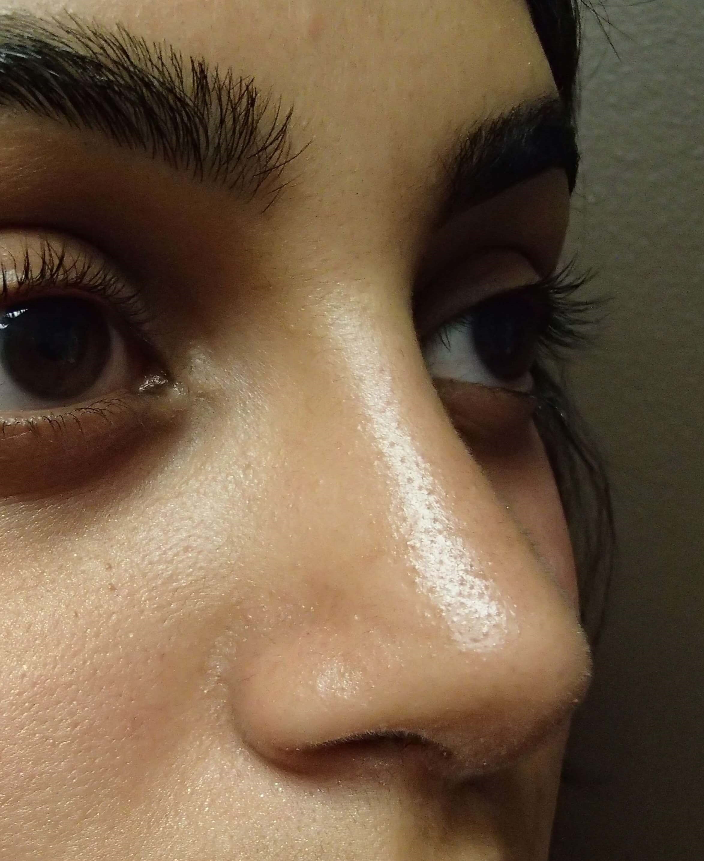 Rhinoplasty (nose job) After