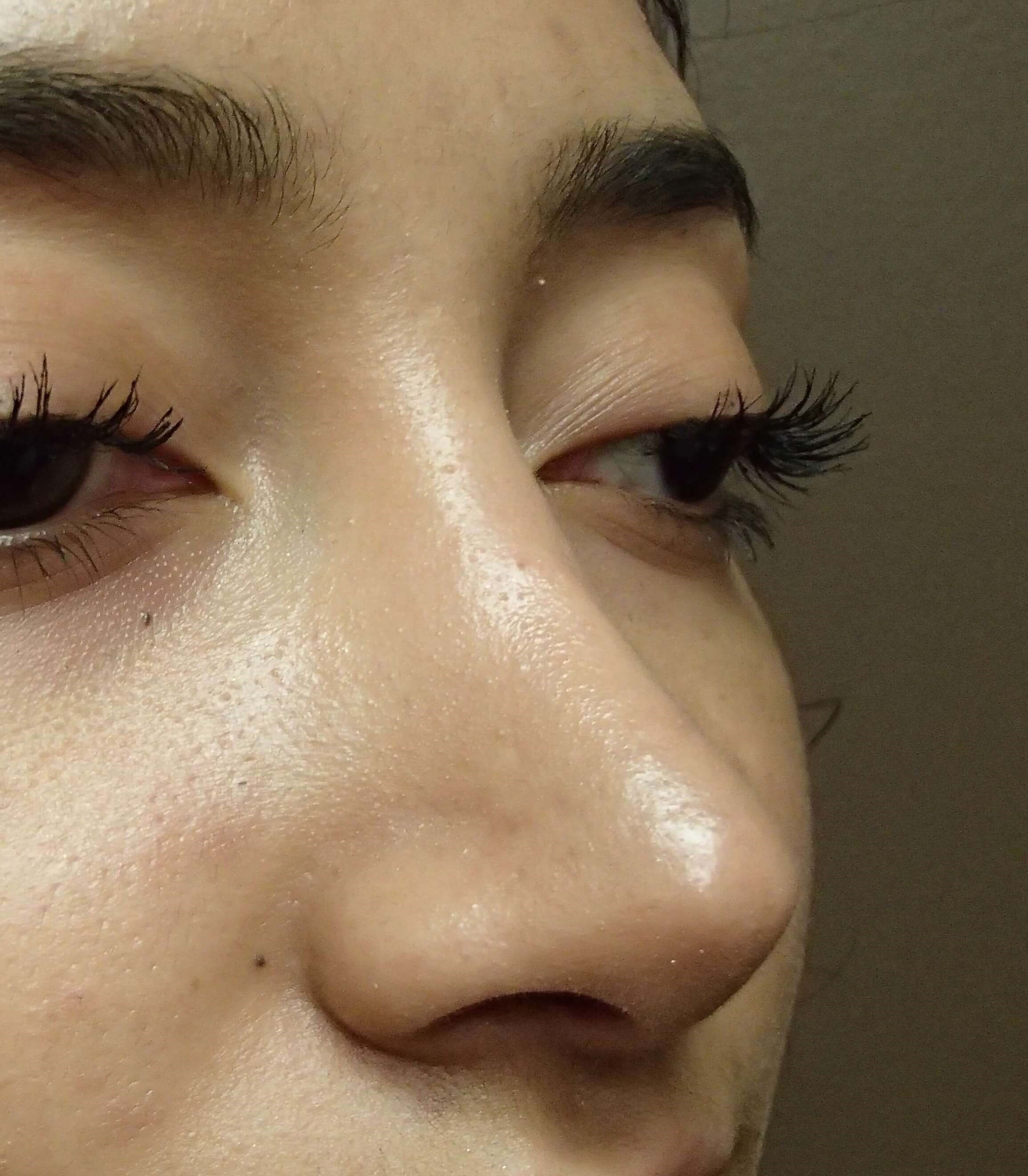 Rhinoplasty (nose job) After