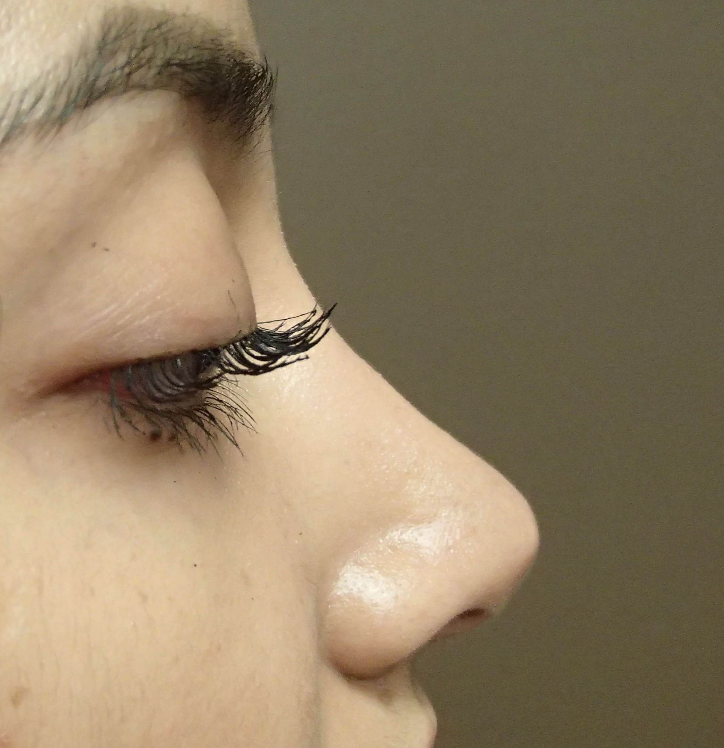 Rhinoplasty (nose job) After