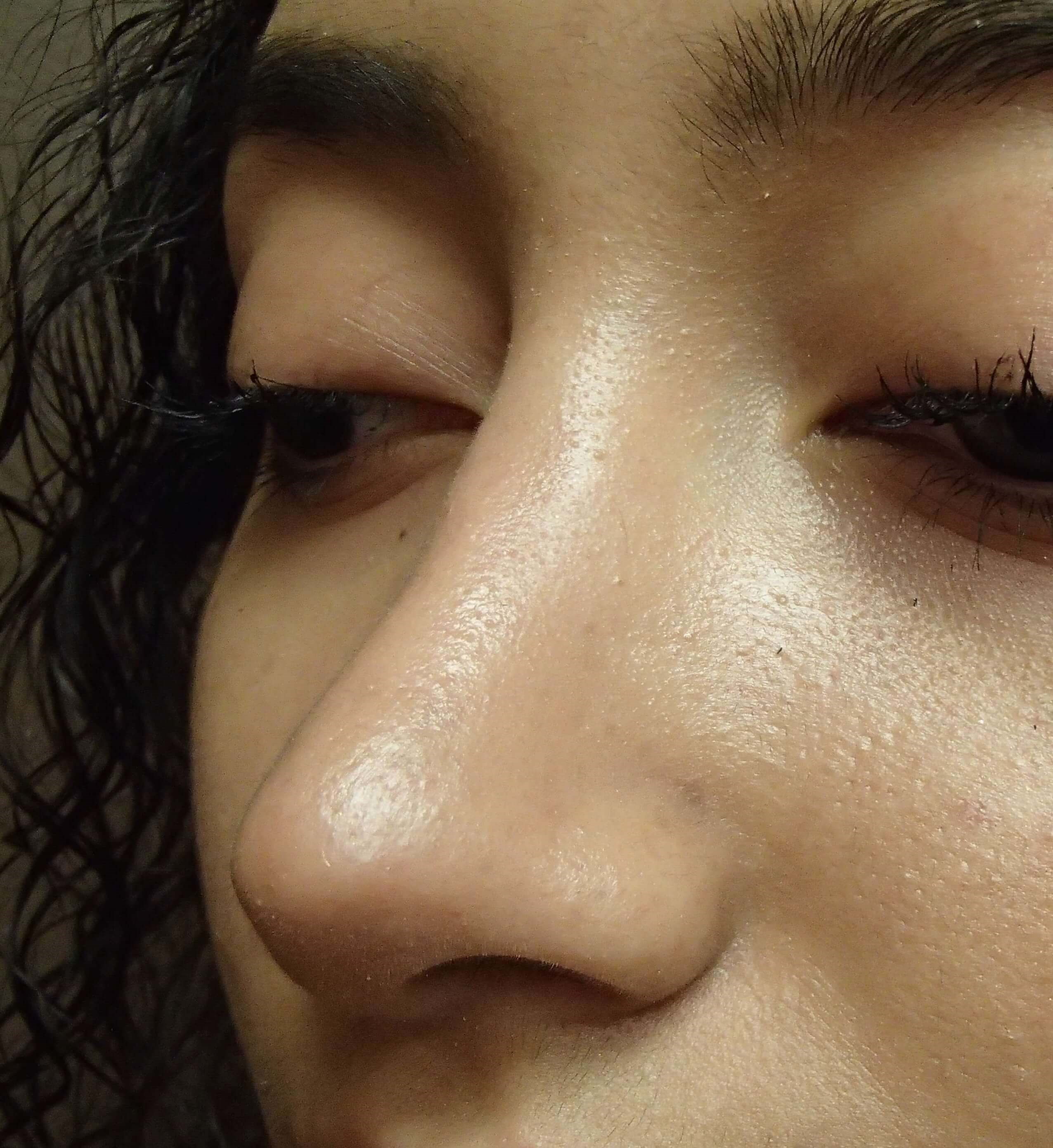 Rhinoplasty (nose job) After