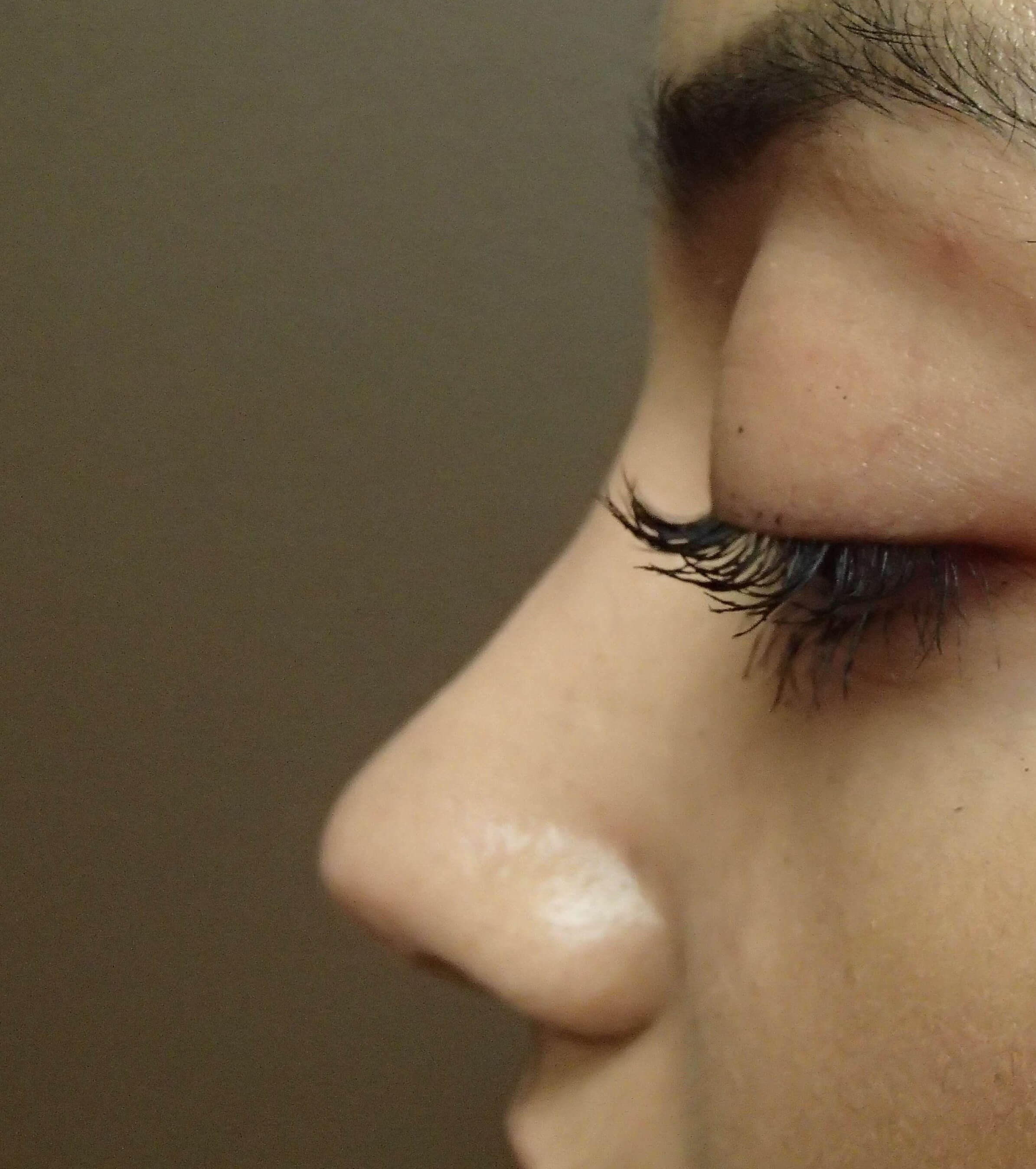 Rhinoplasty (nose job) After
