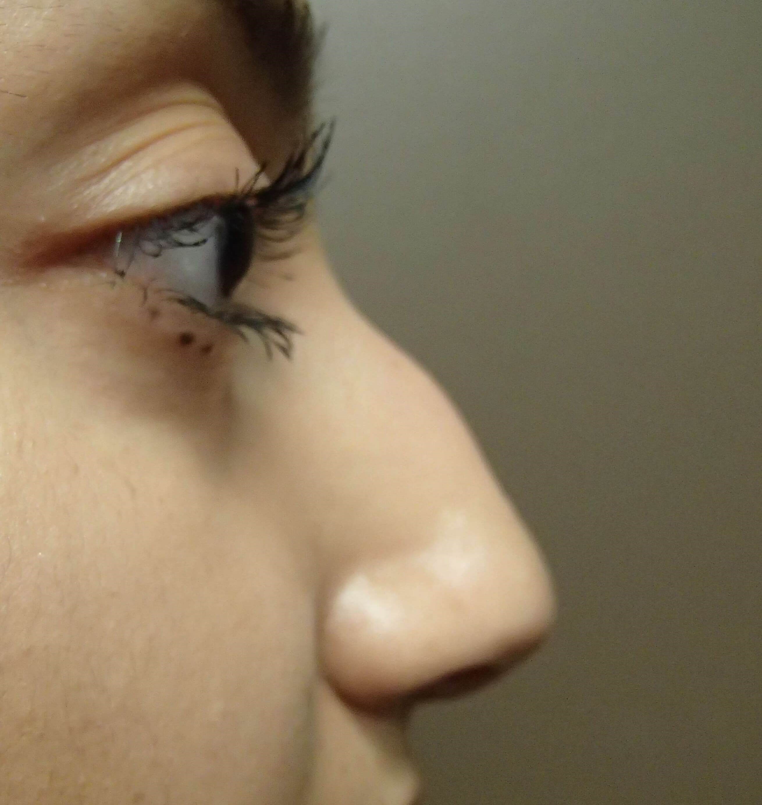 Rhinoplasty (nose job) Before