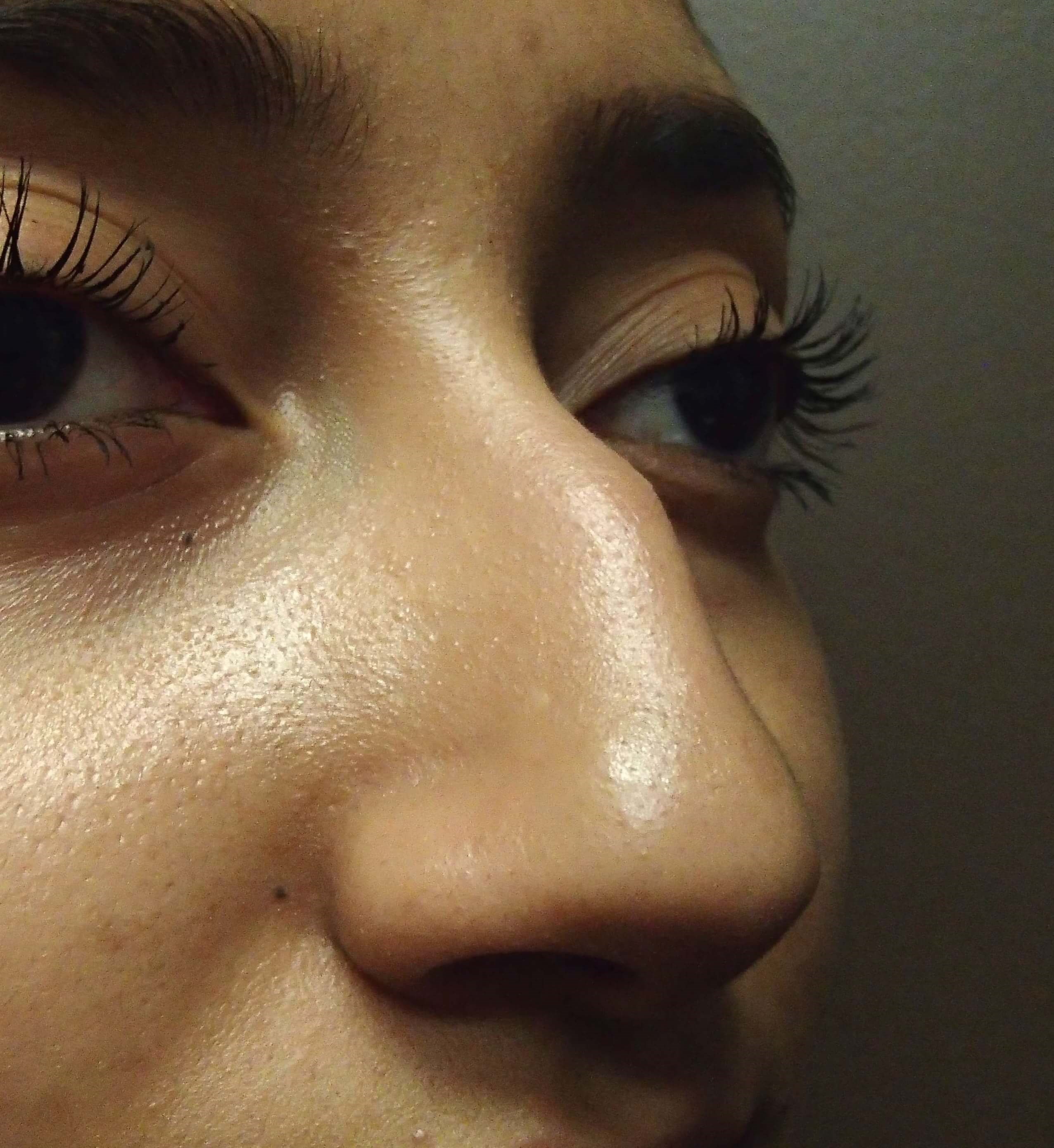Rhinoplasty (nose job) Before