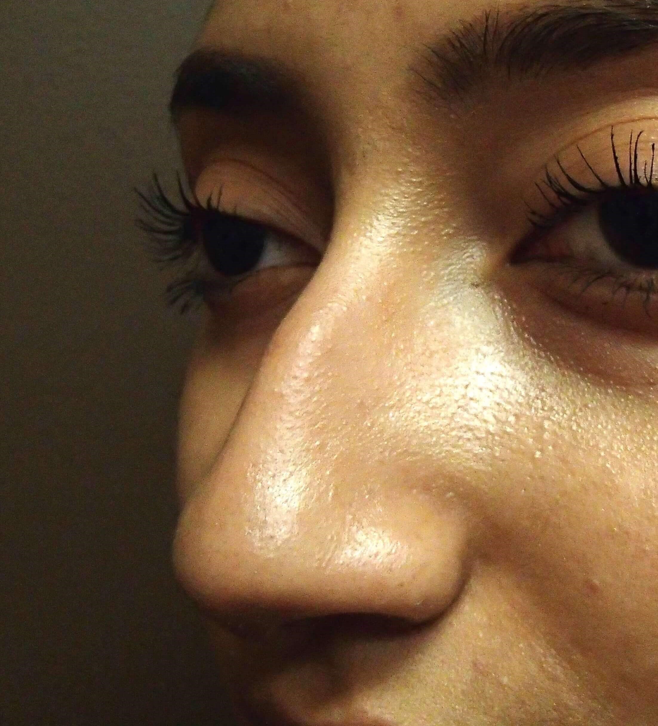 Rhinoplasty (nose job) Before