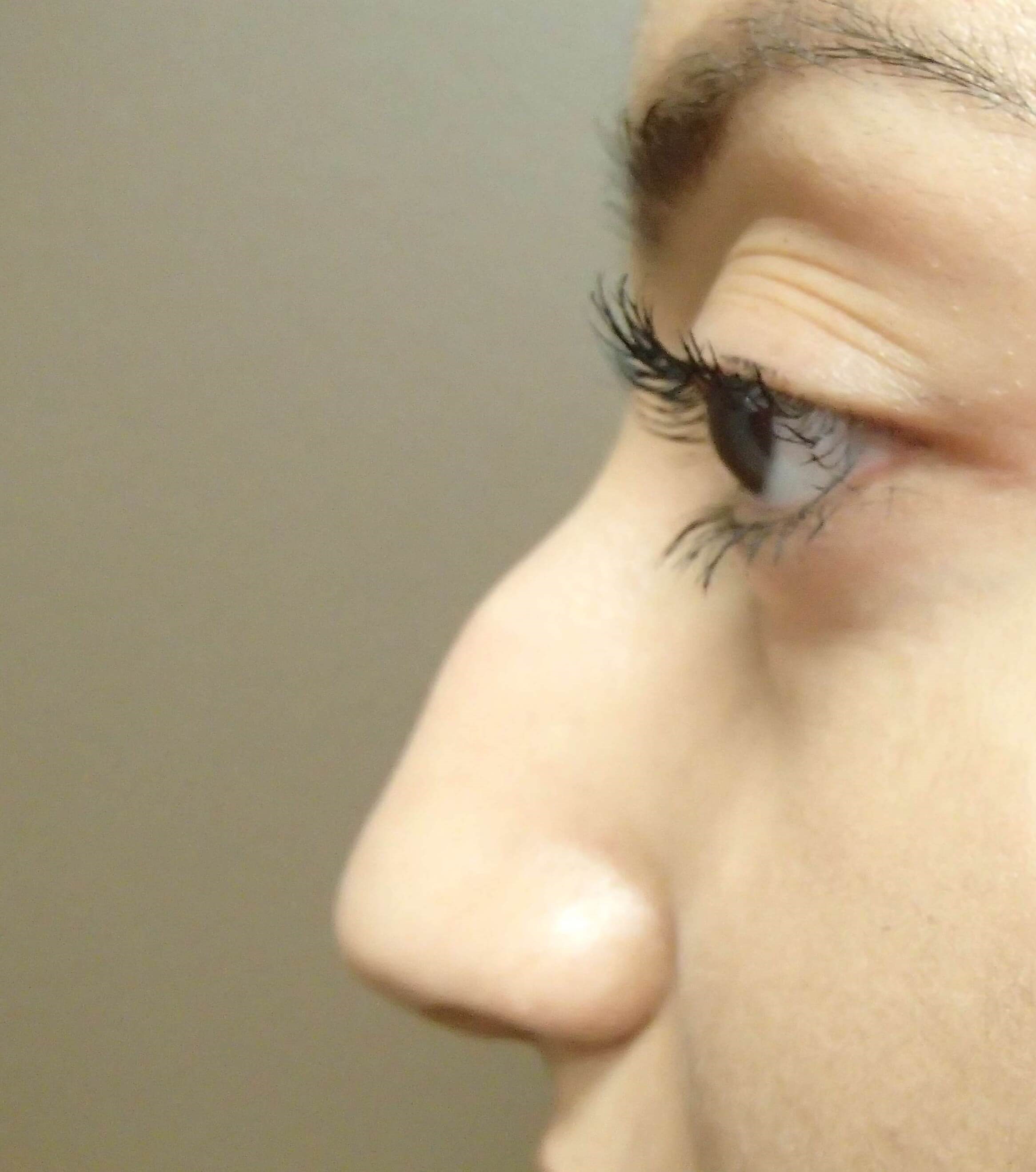 Rhinoplasty (nose job) Before