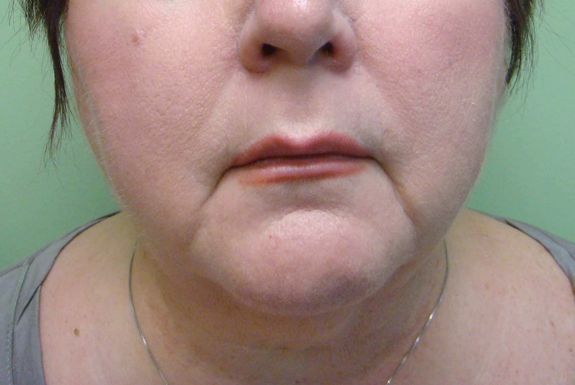 Necklift Before