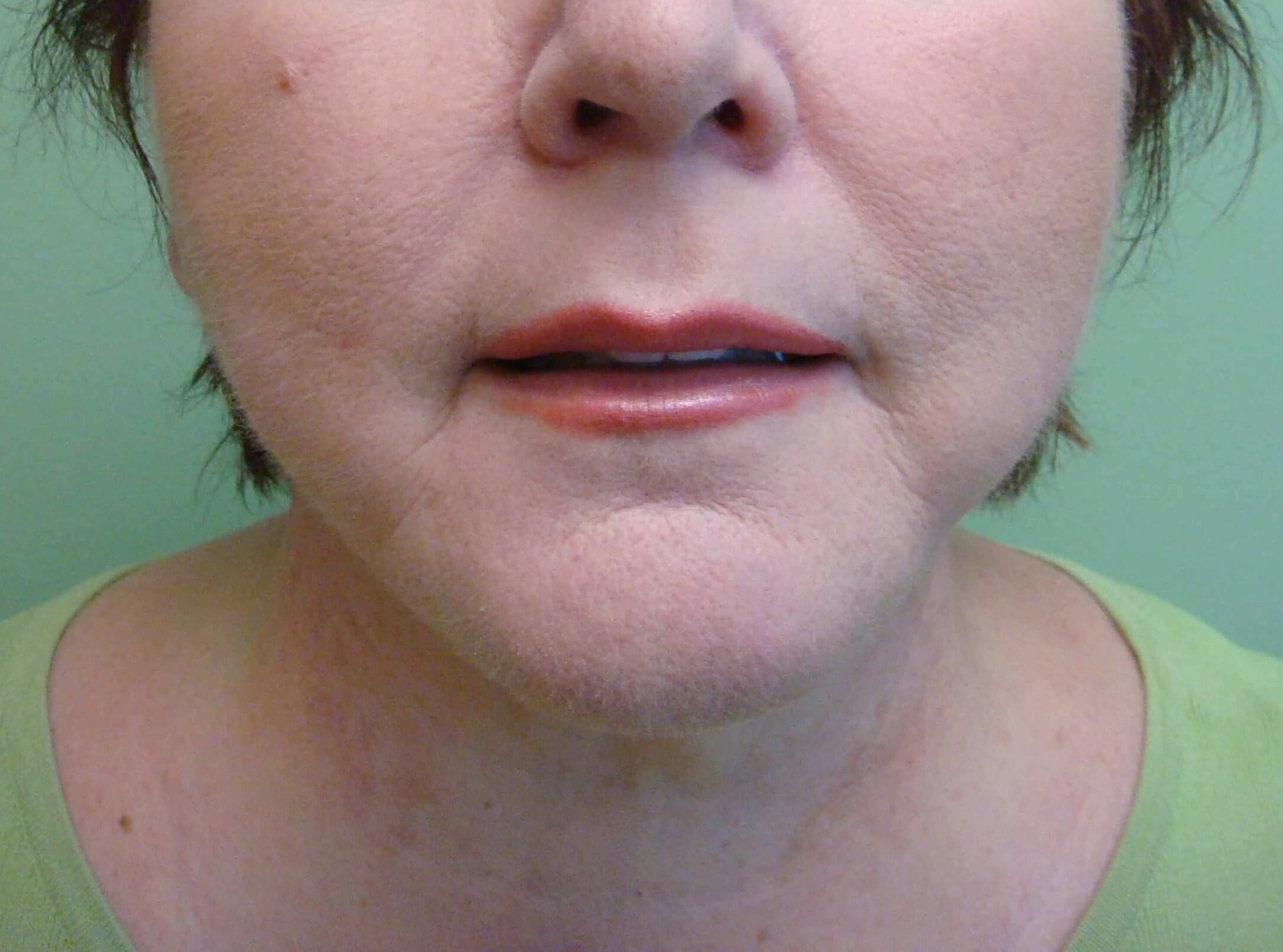 Necklift After