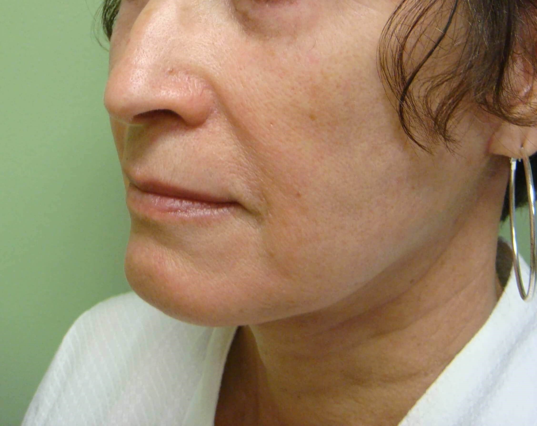 Facelift and Necklift After