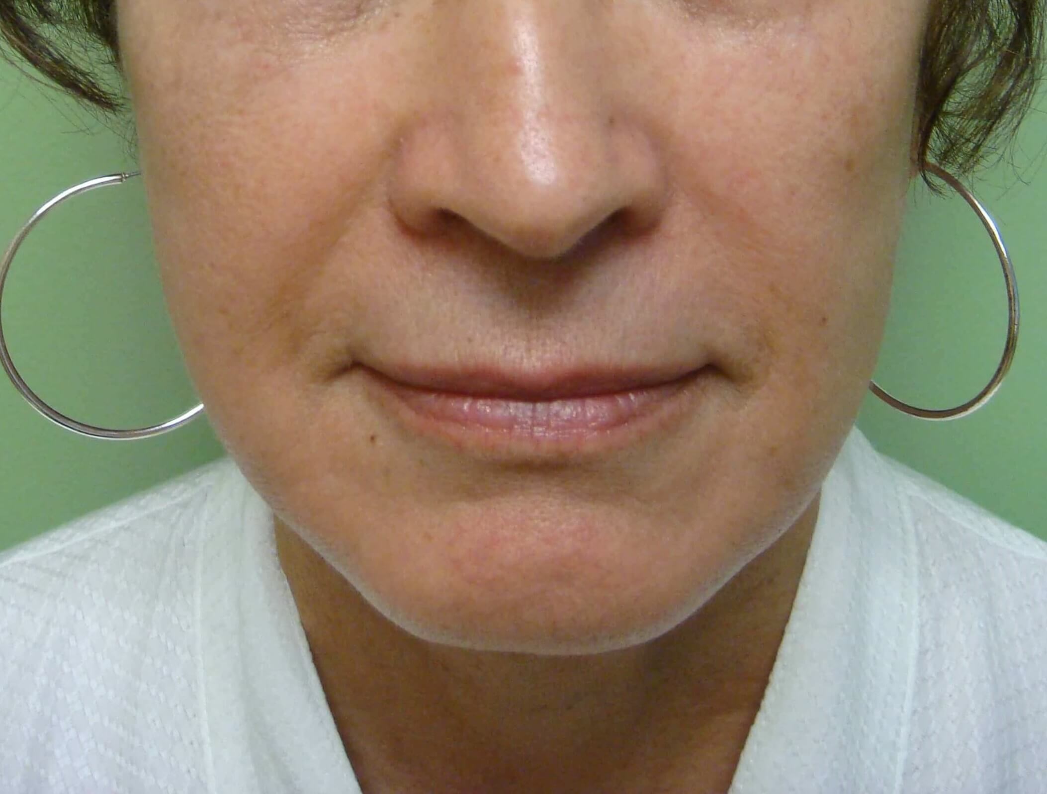 Facelift and Necklift After