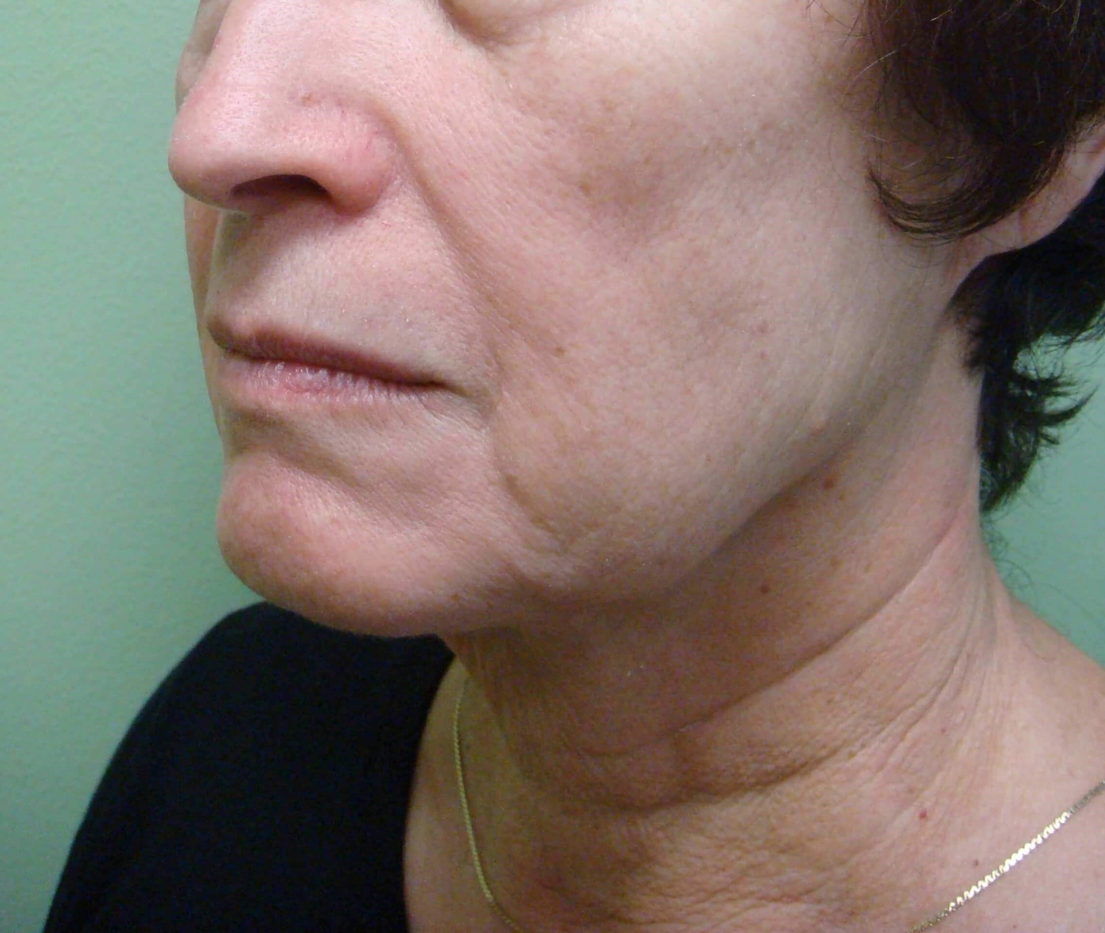 Facelift and Necklift Before