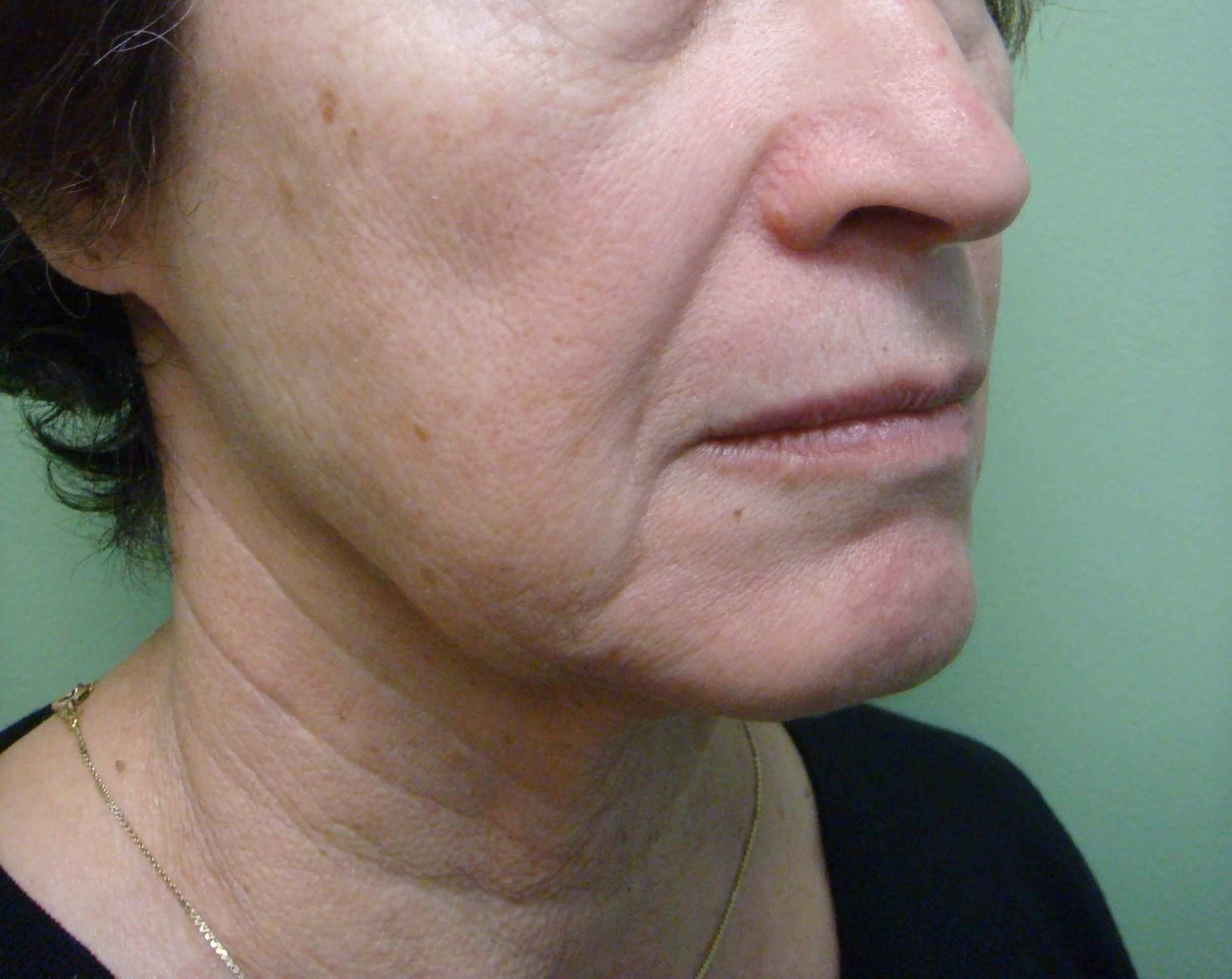 Facelift and Necklift Before