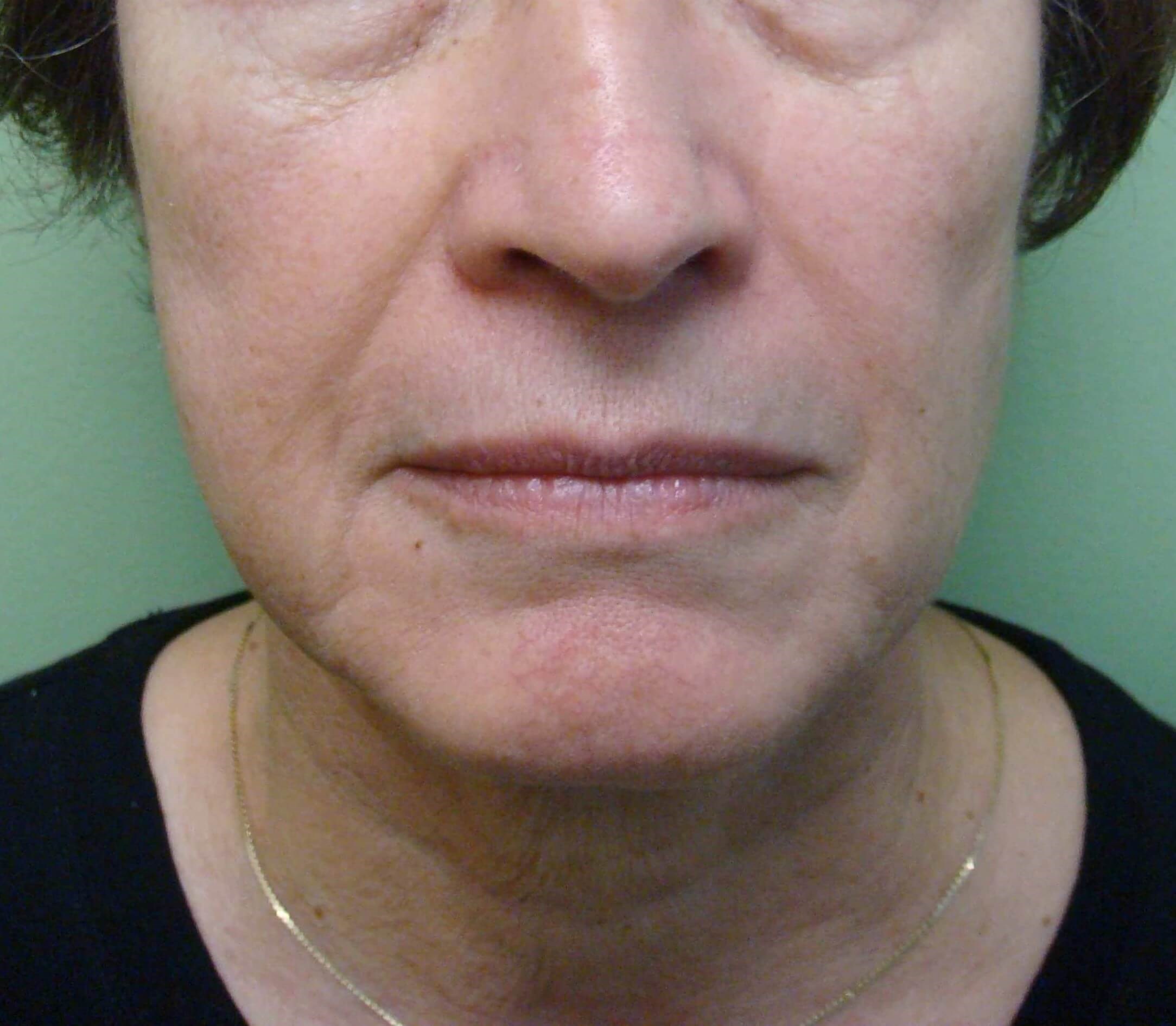 Facelift and Necklift Before