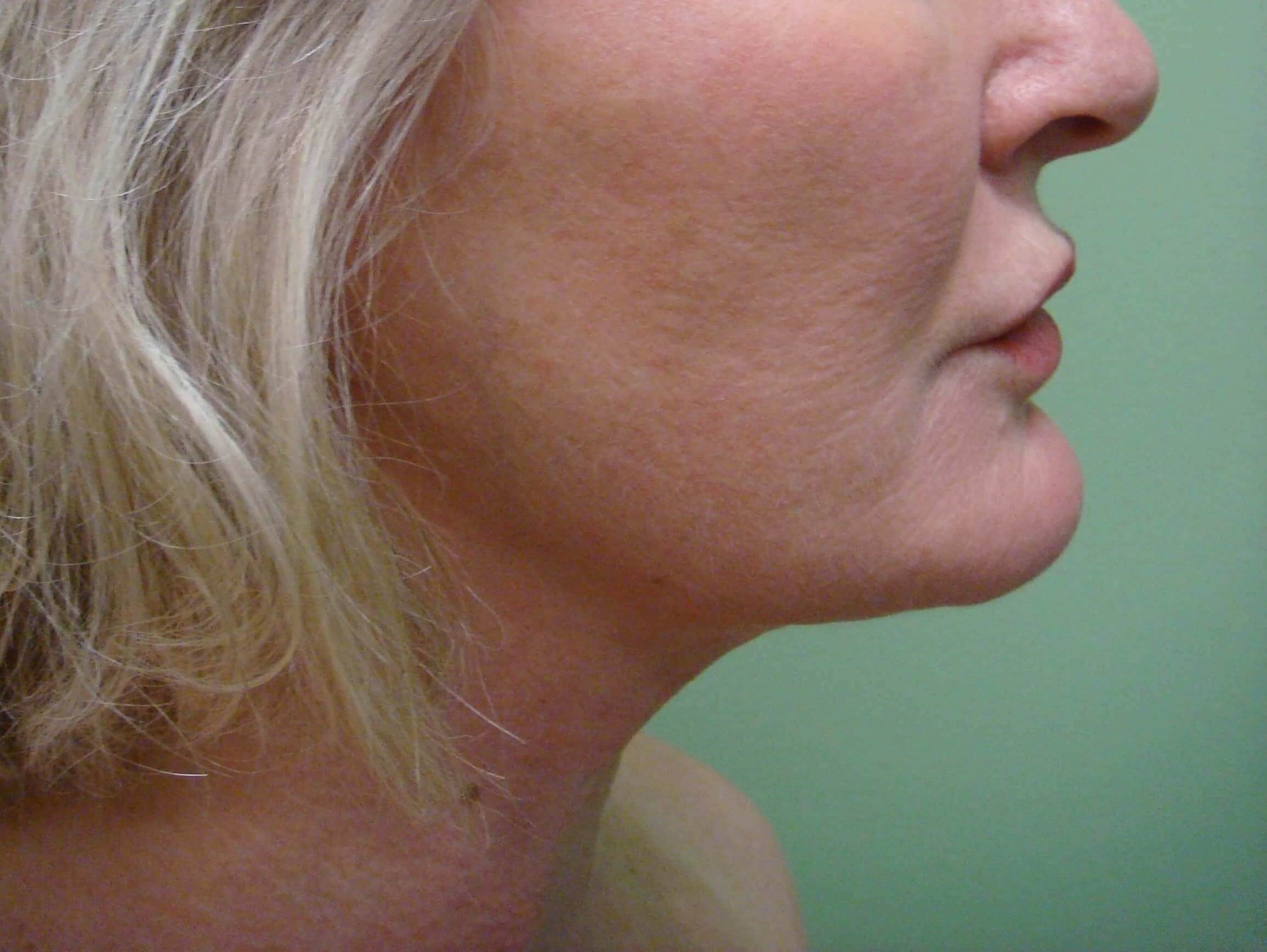 Facelift and Necklift After