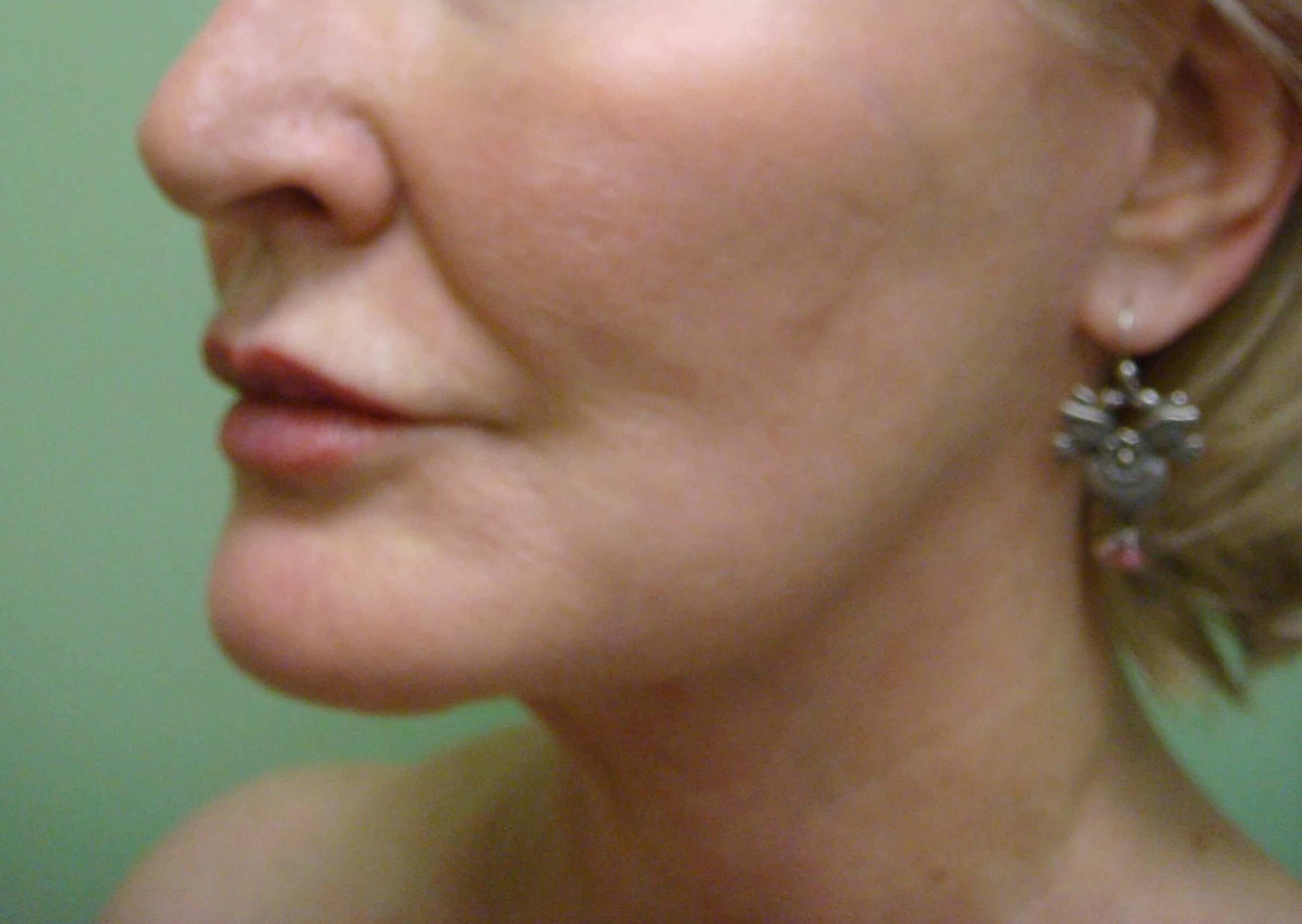 Facelift and Necklift After