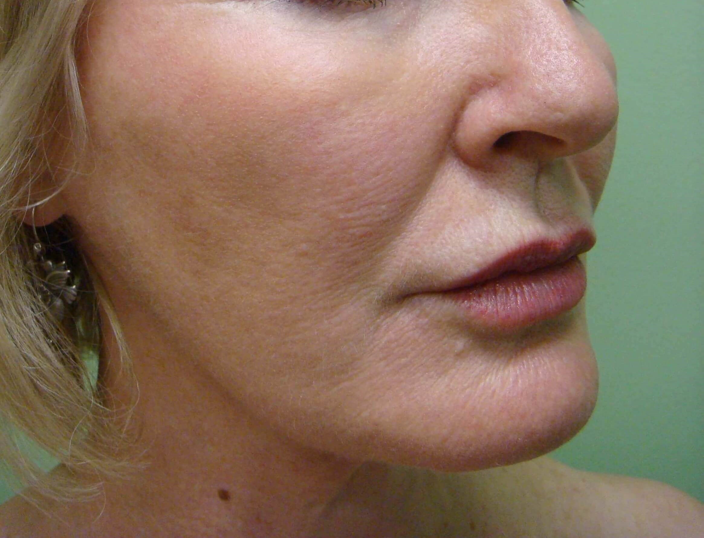 Facelift and Necklift After