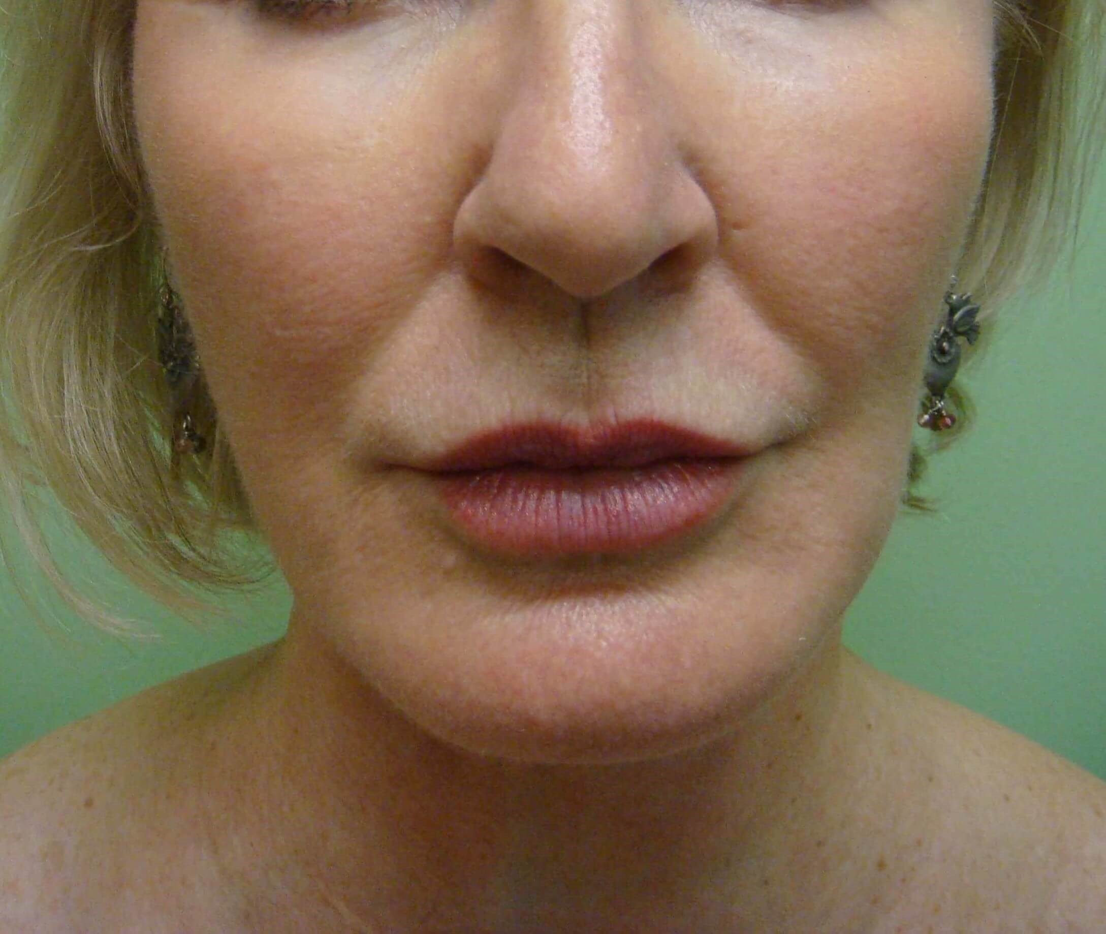Facelift and Necklift After