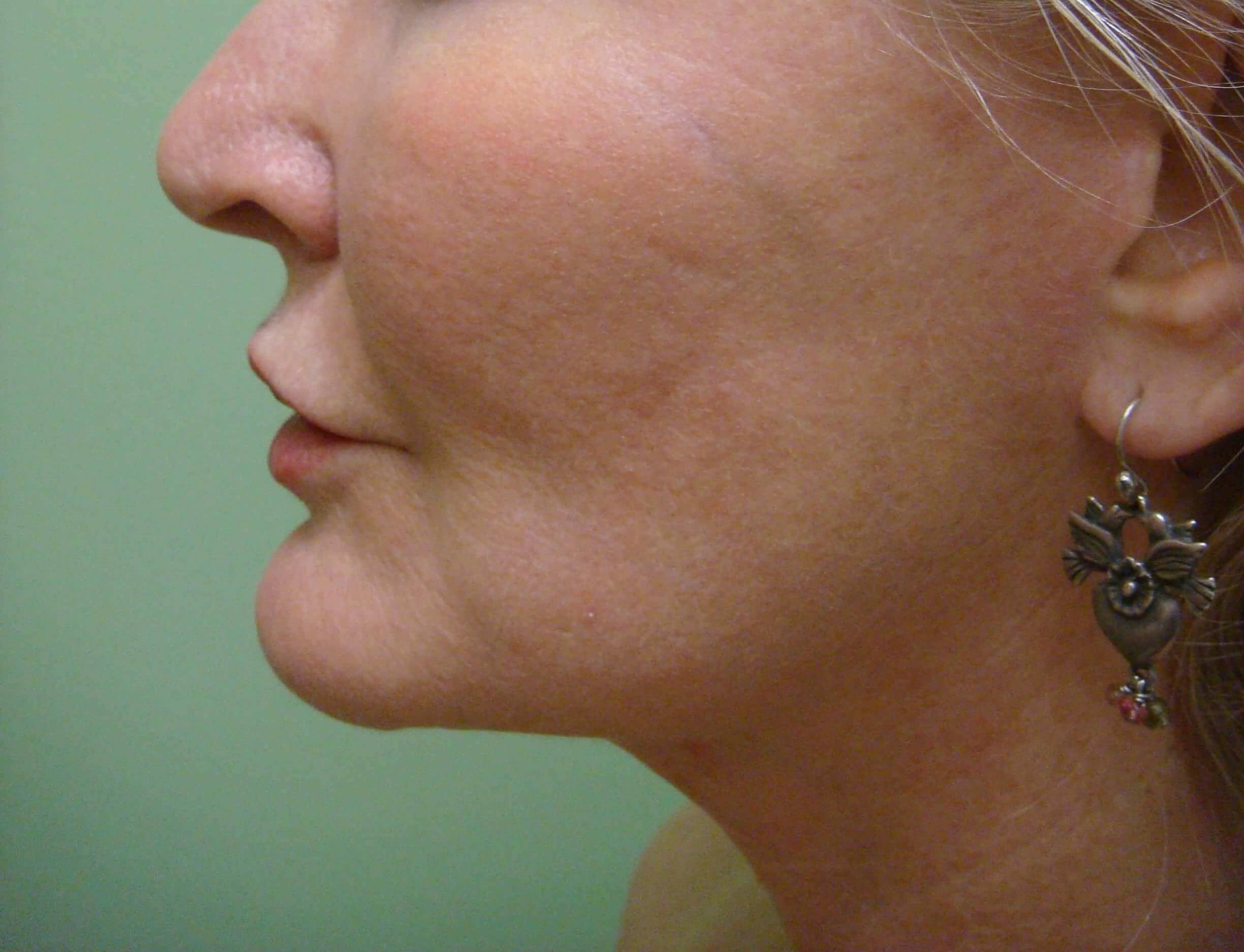 Facelift and Necklift After