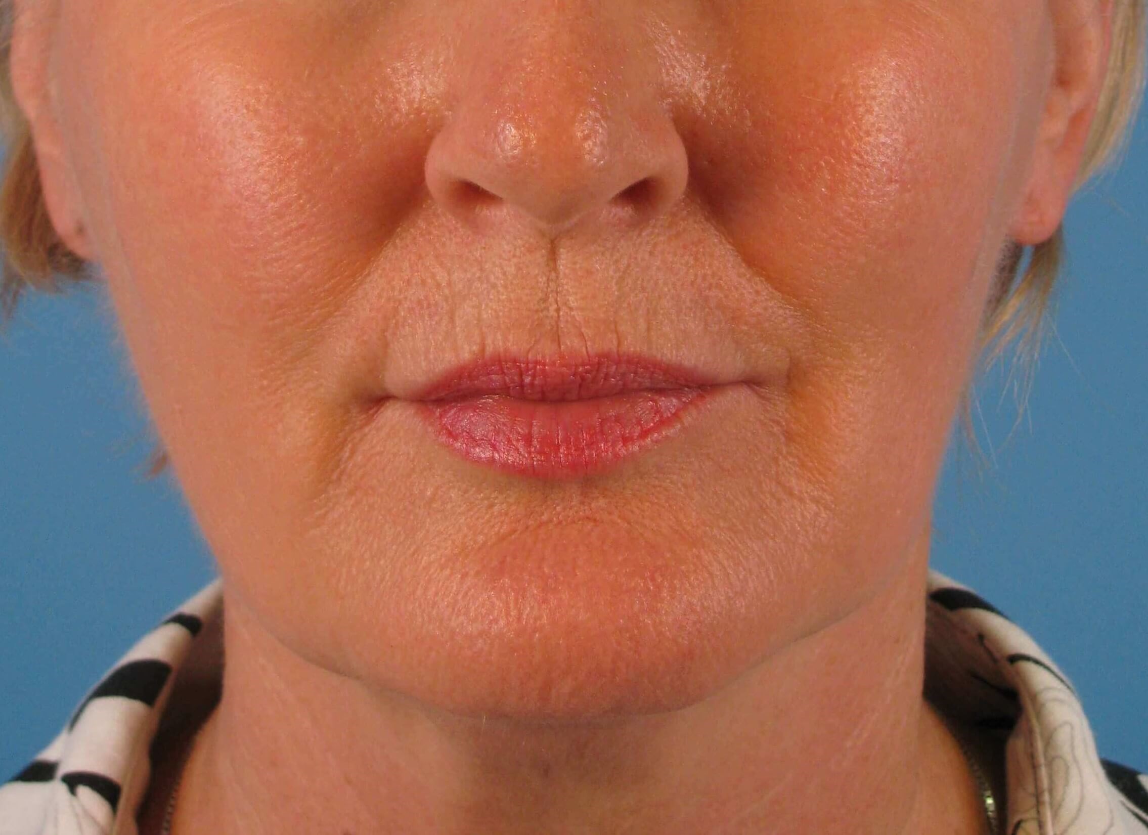 Facelift and Necklift Before