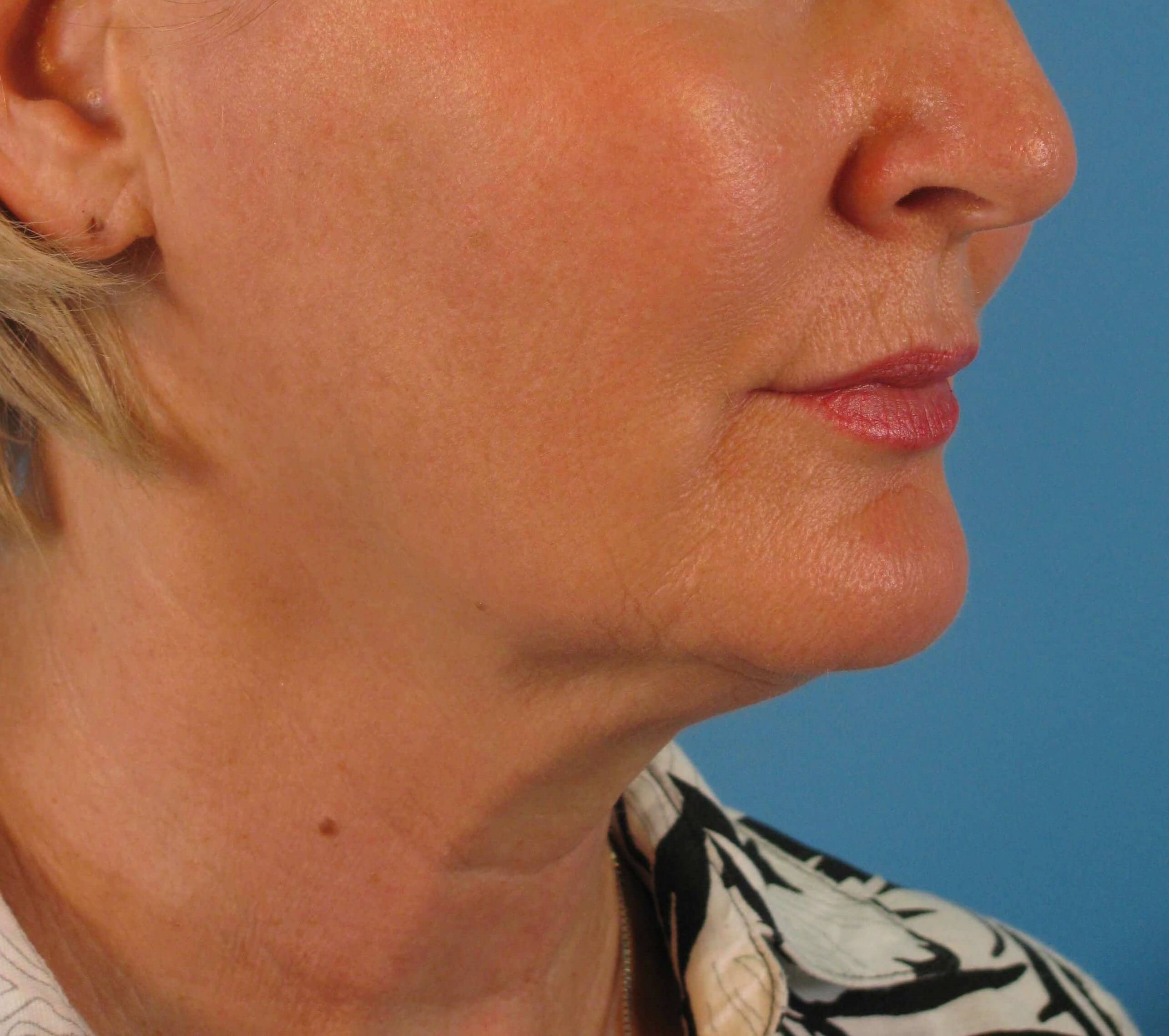 Facelift and Necklift Before