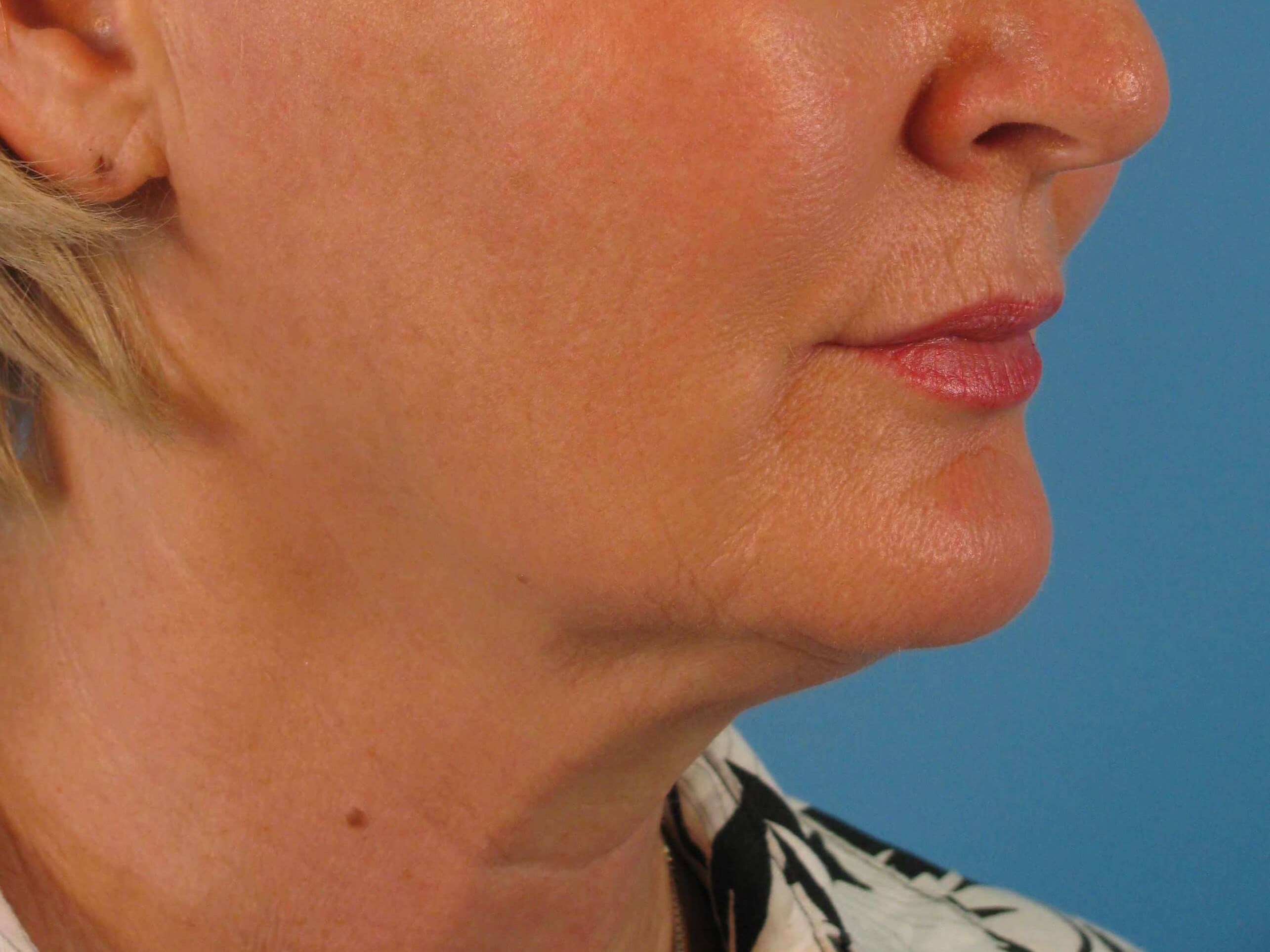 Facelift and Necklift Before