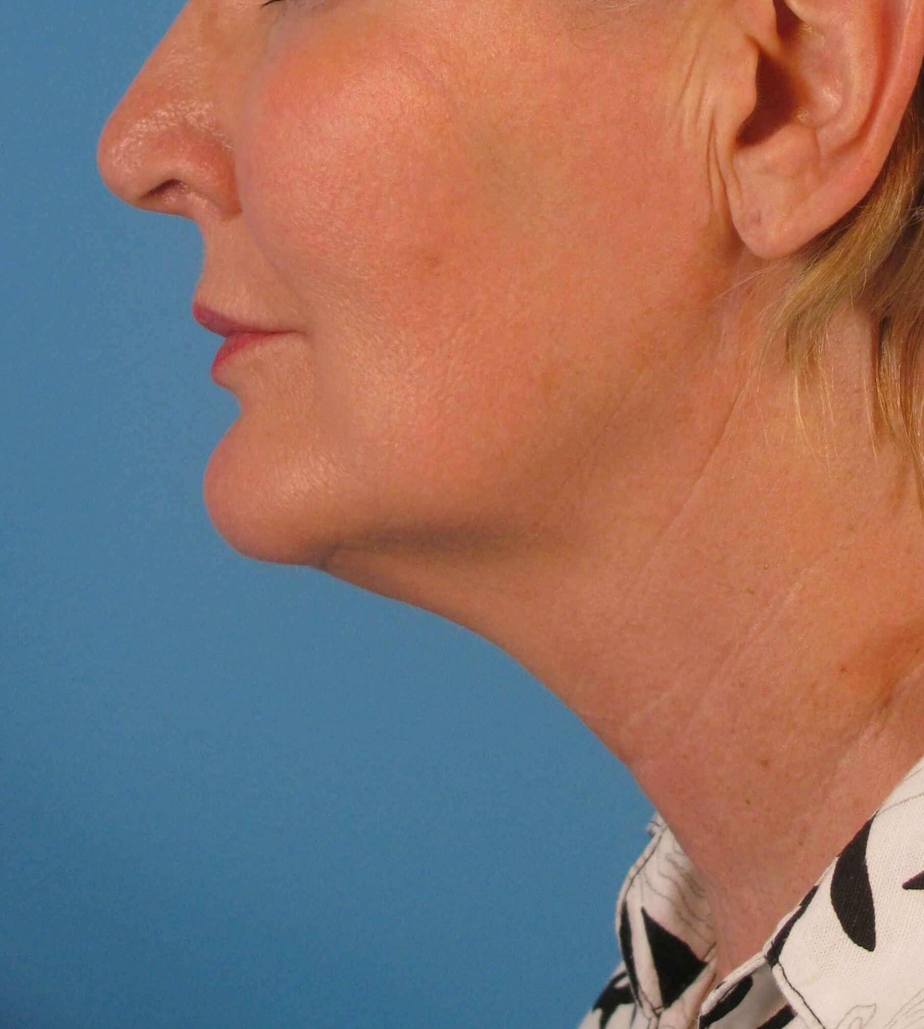 Facelift and Necklift Before