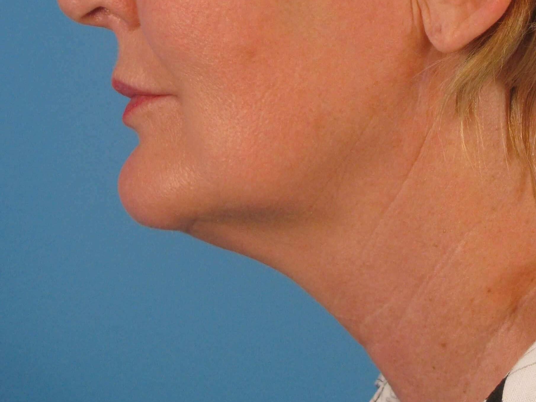 Facelift and Necklift Before