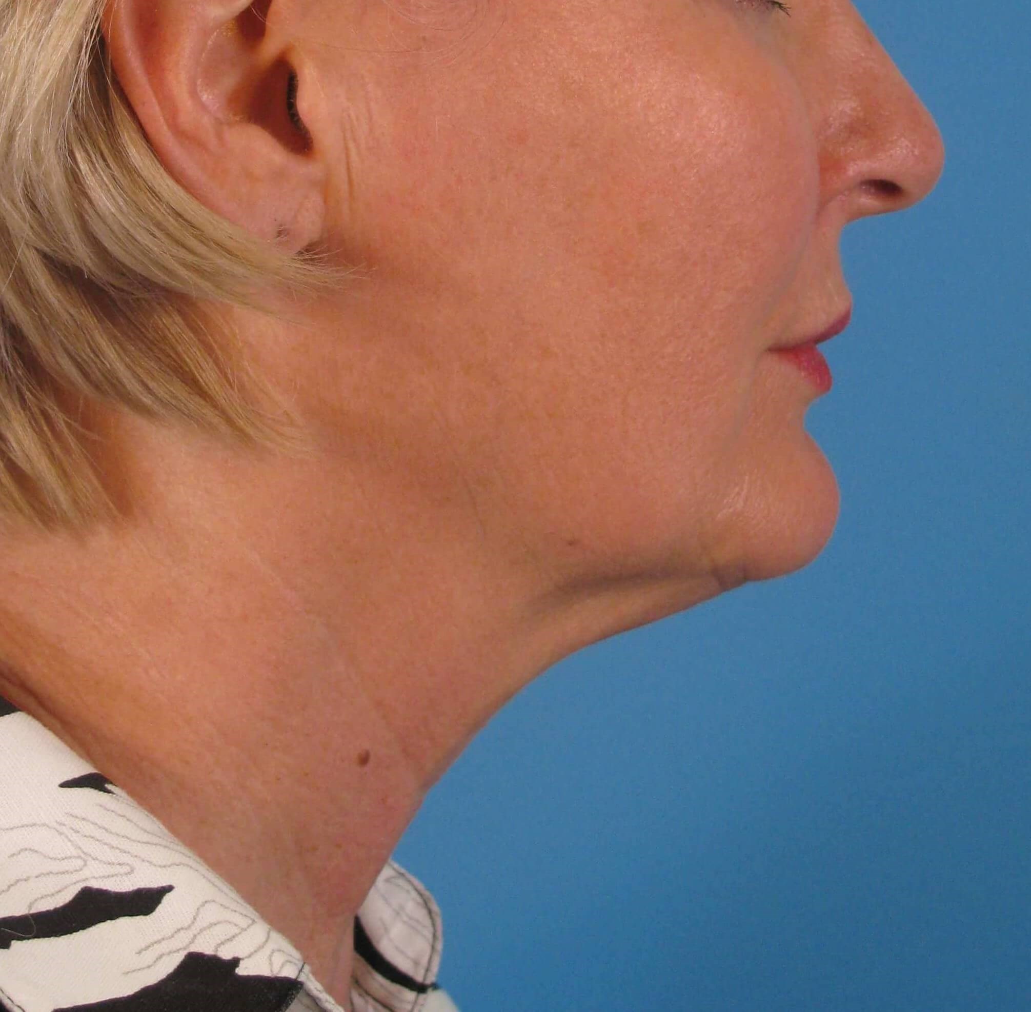 Facelift and Necklift Before