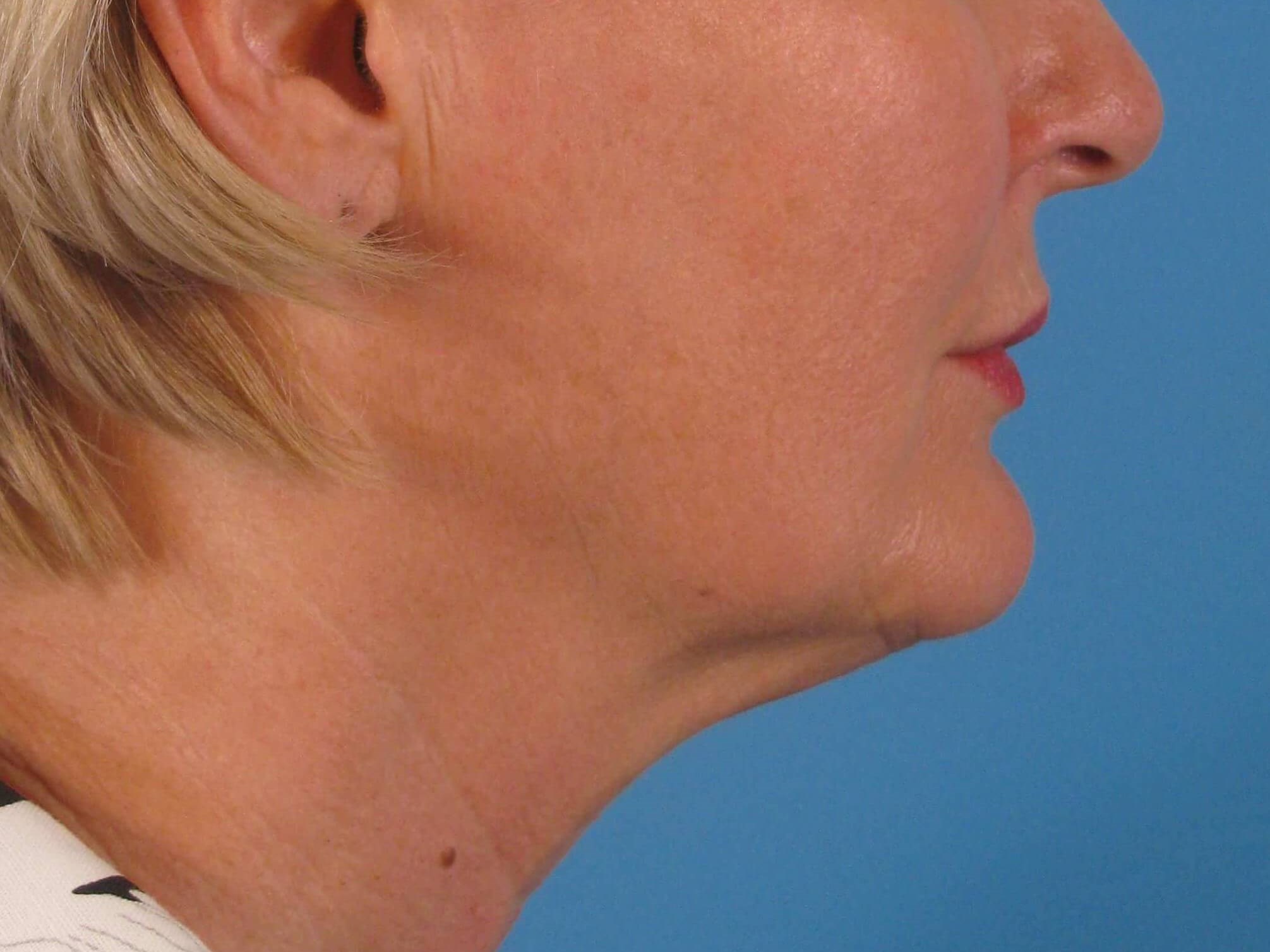 Facelift and Necklift Before