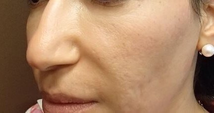 Juvederm Before