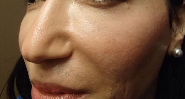 Juvederm After