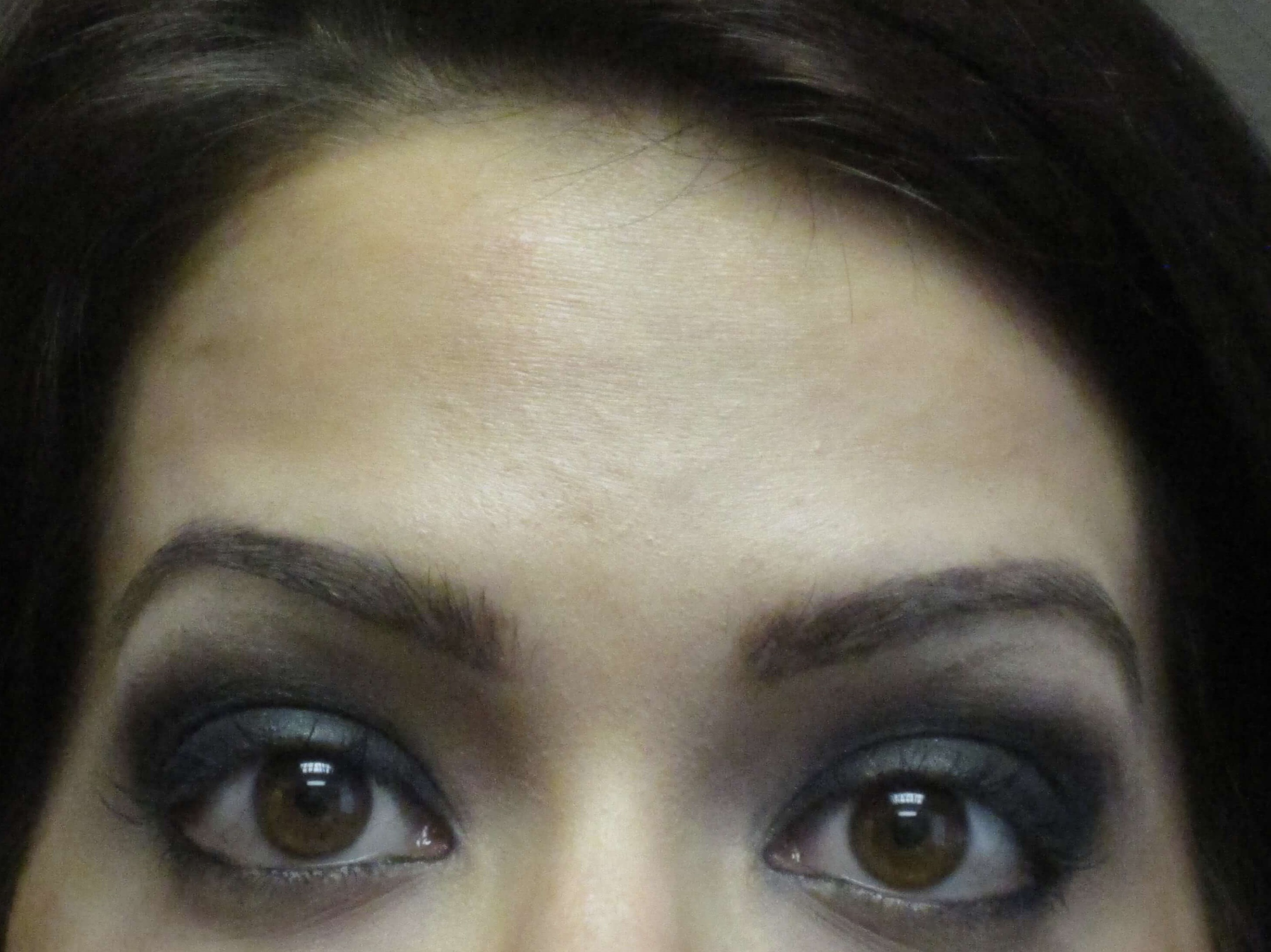 Botox After