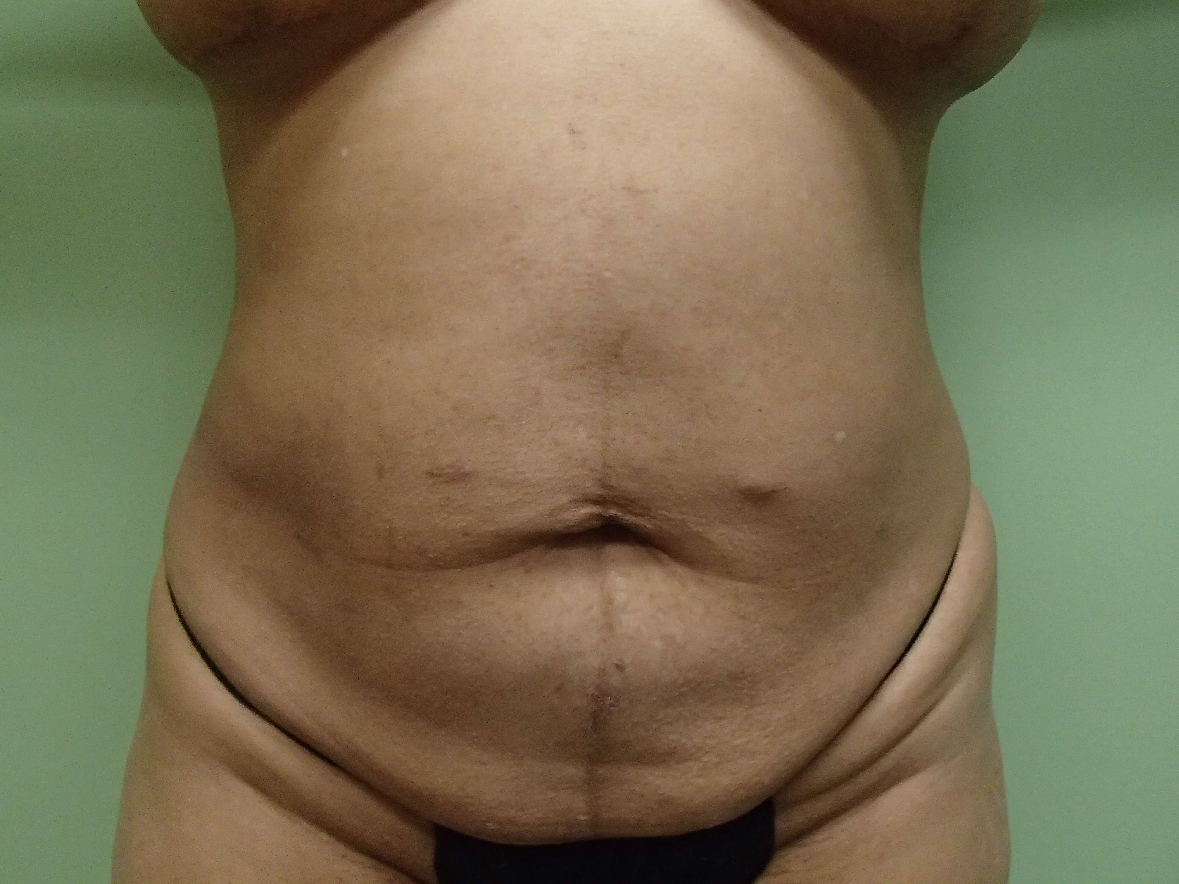 Abdominoplasty w/ Liposuction Before