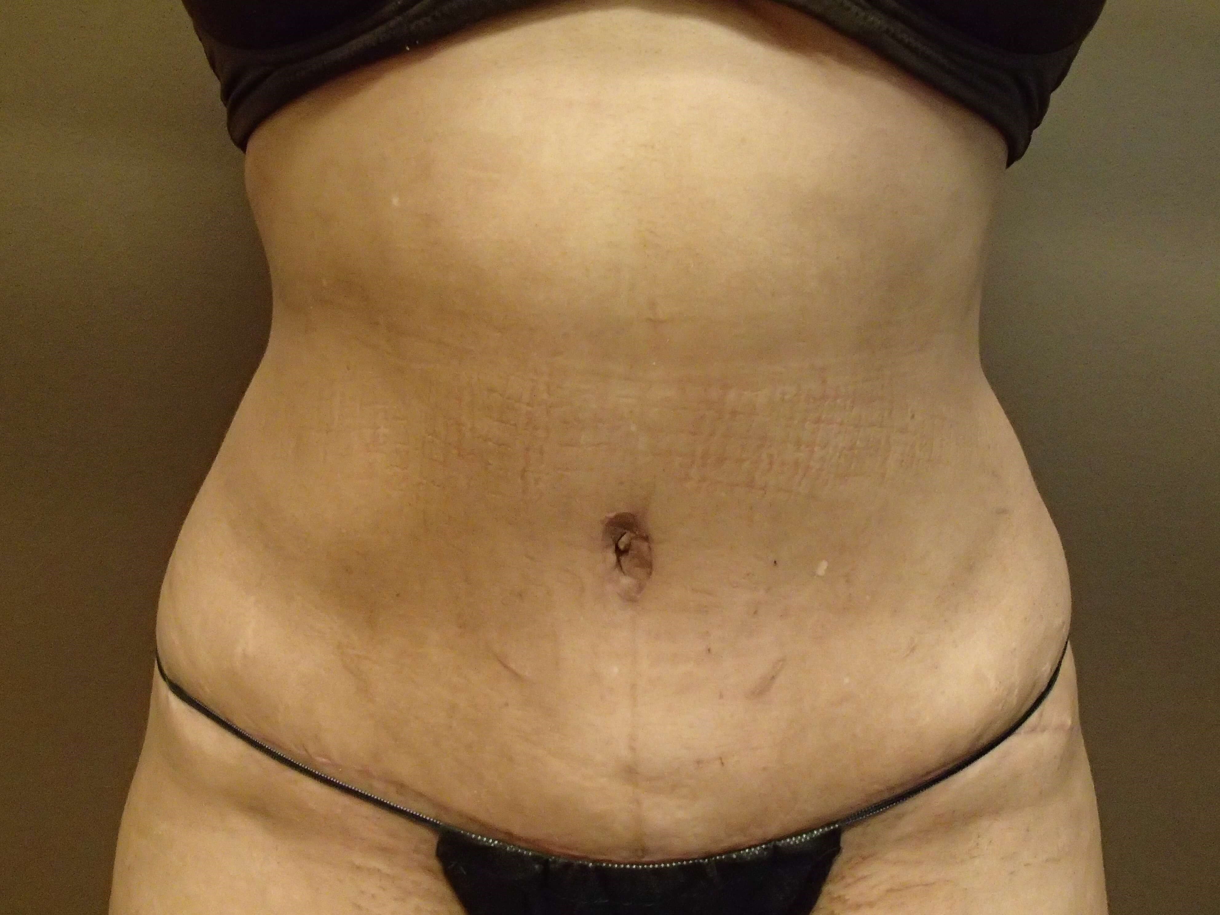 Abdominoplasty w/ Liposuction After