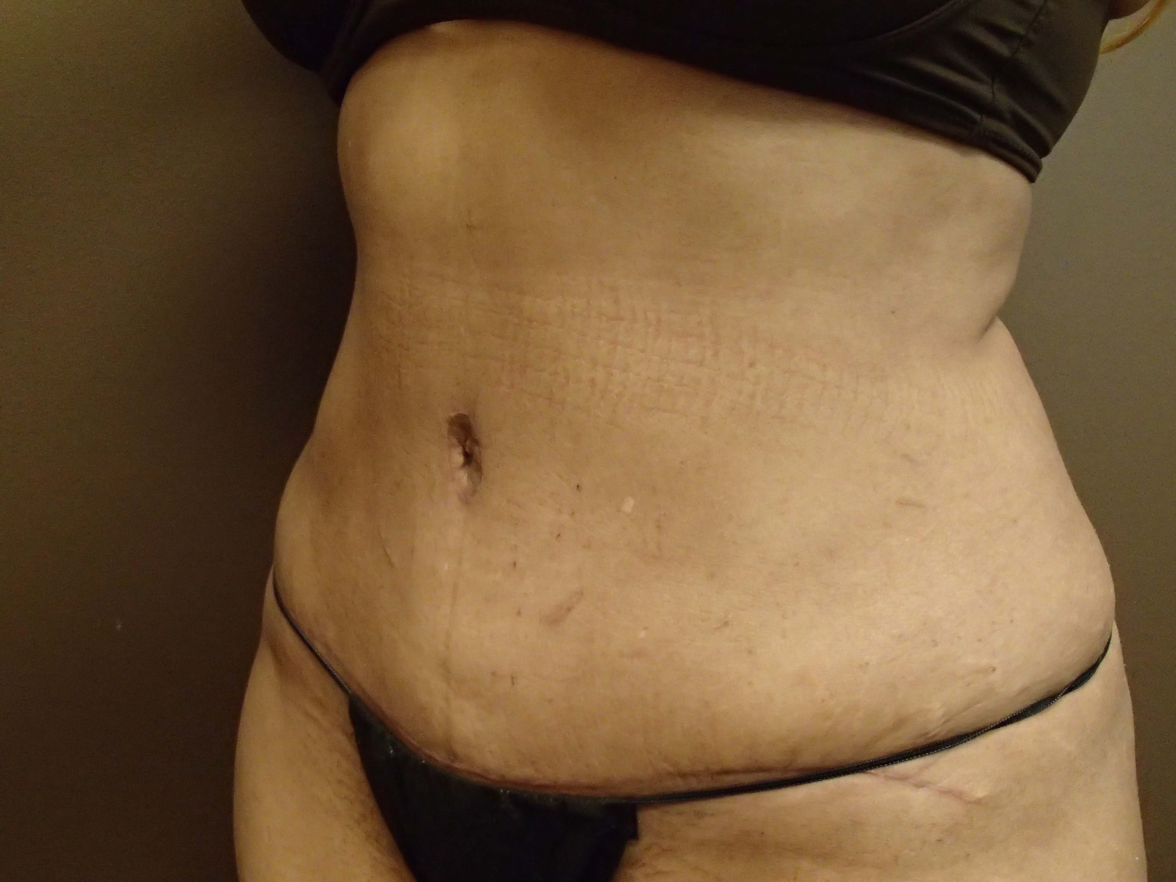 Abdominoplasty w/ Liposuction After