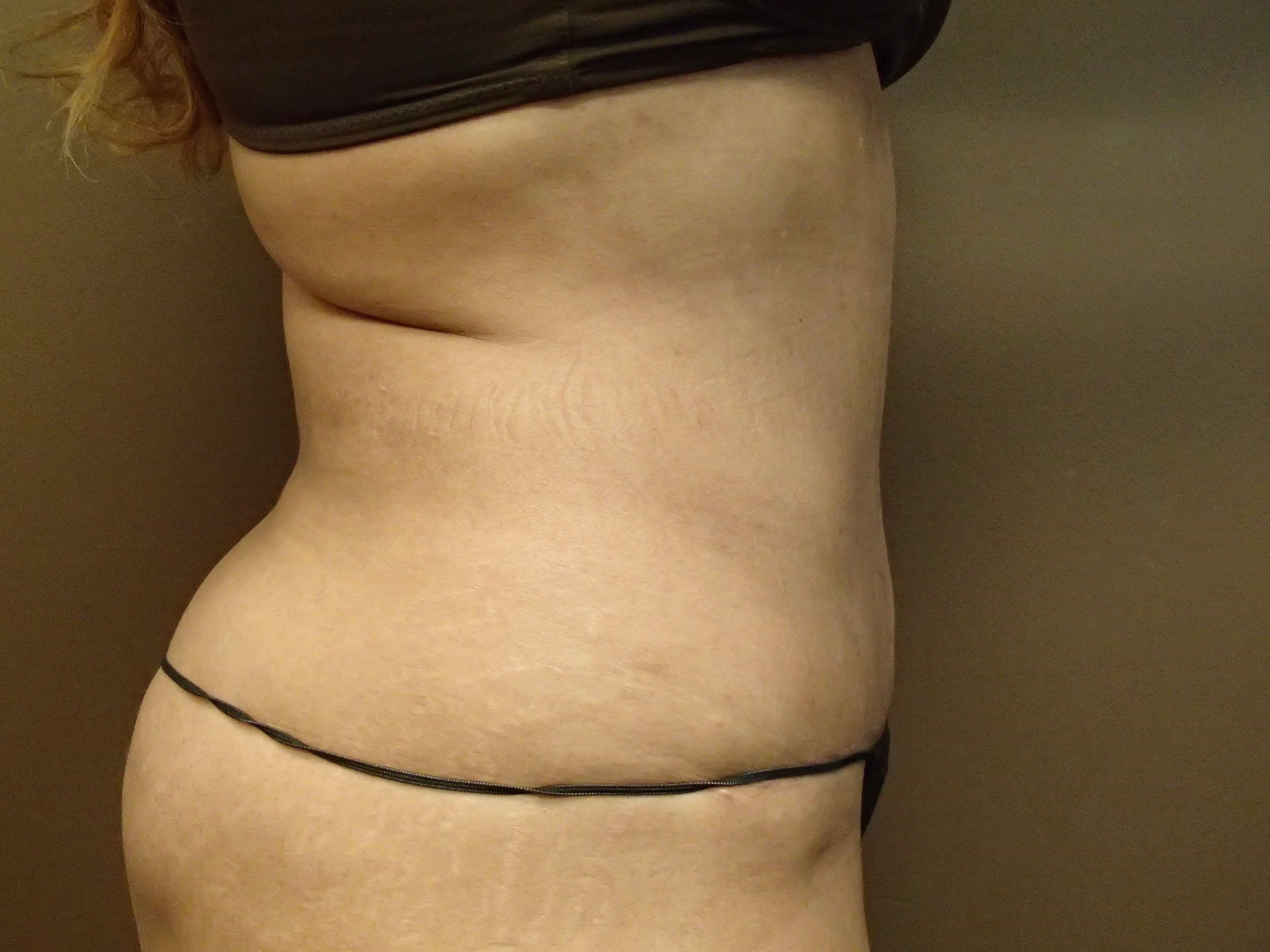Abdominoplasty w/ Liposuction After