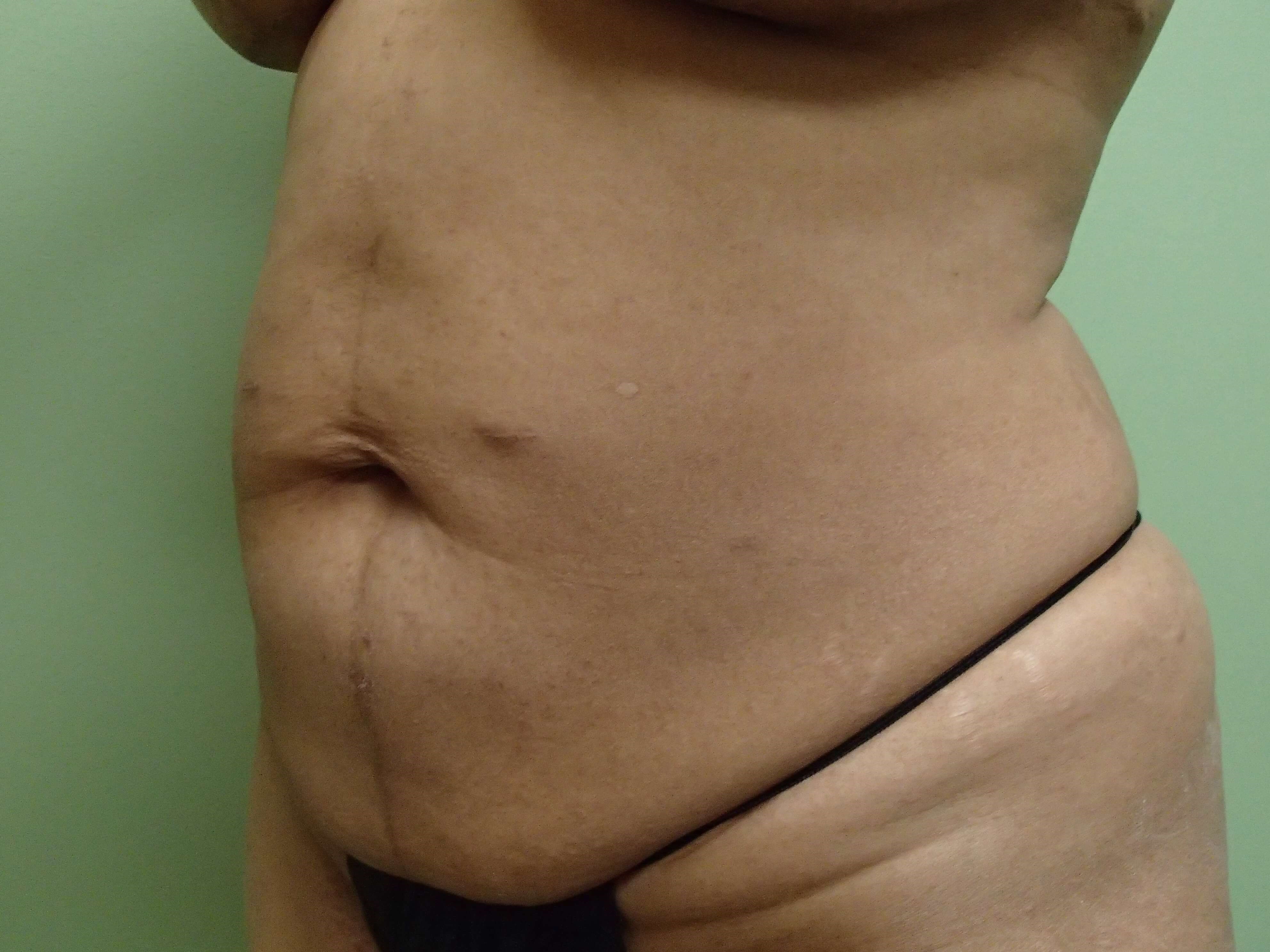 Abdominoplasty w/ Liposuction Before