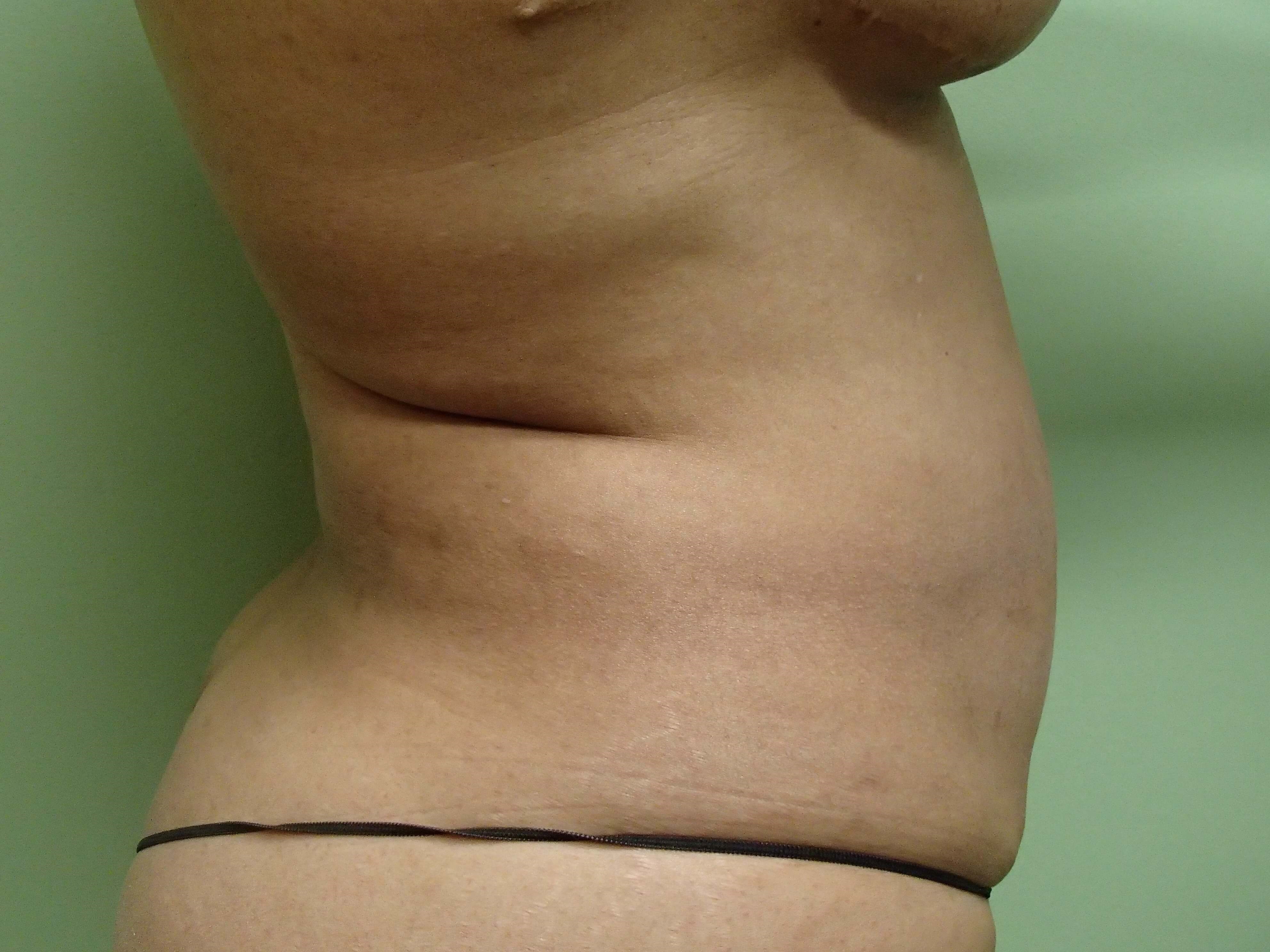 Abdominoplasty w/ Liposuction Before