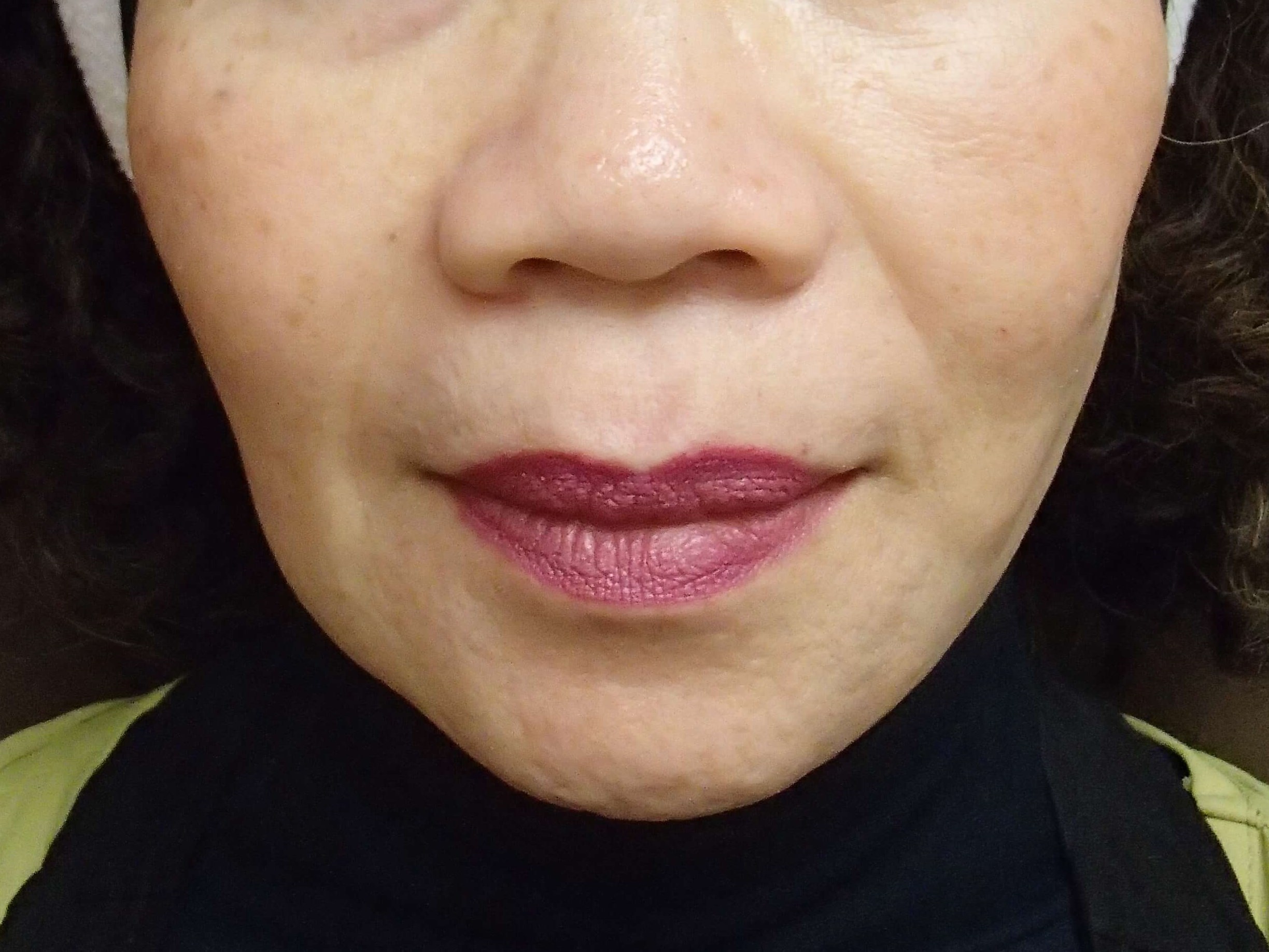 Facelift with Necklift After