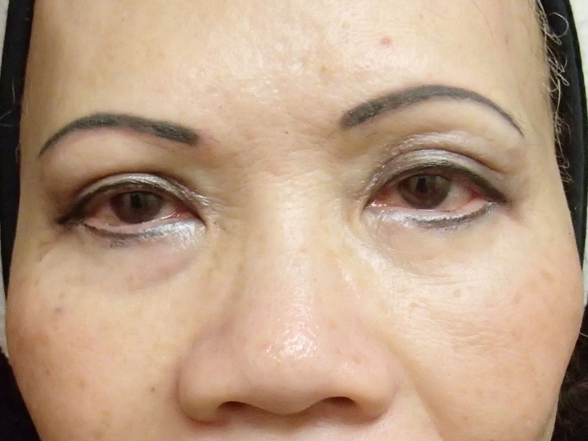 Blepharoplasty After