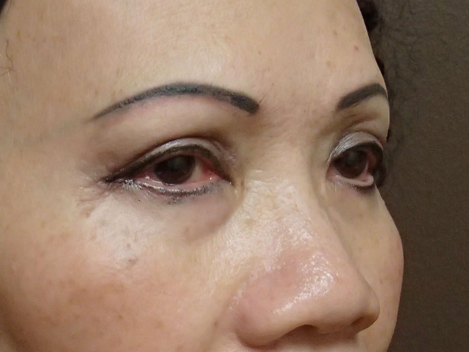Blepharoplasty After