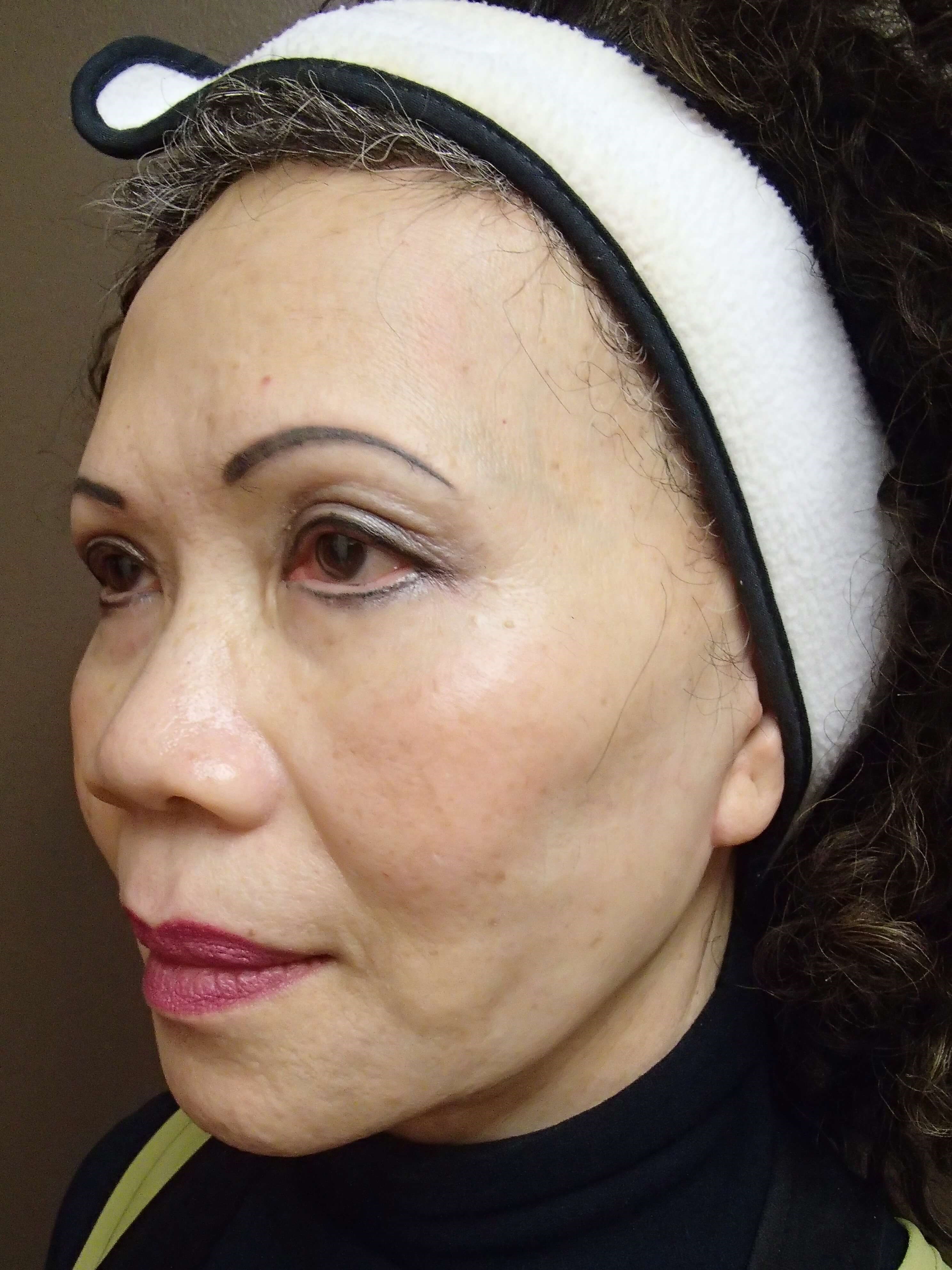 Blepharoplasty After