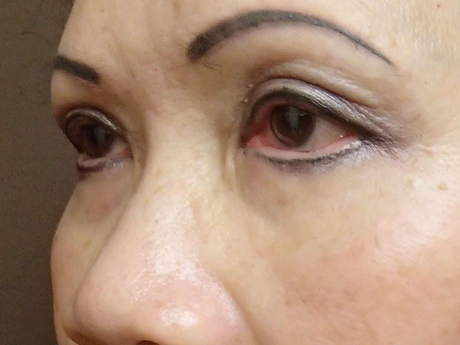 Blepharoplasty After