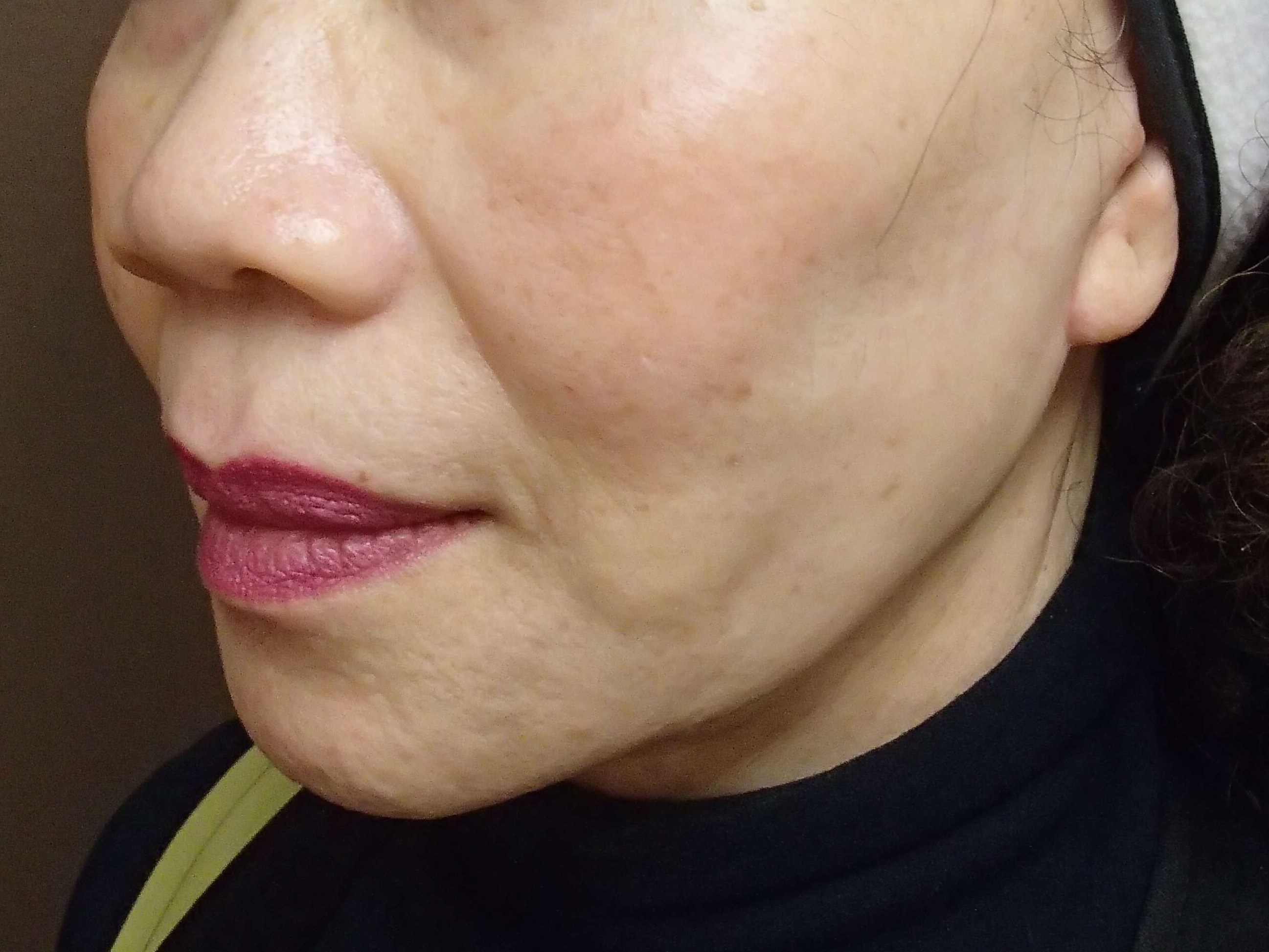 Facelift with Necklift After