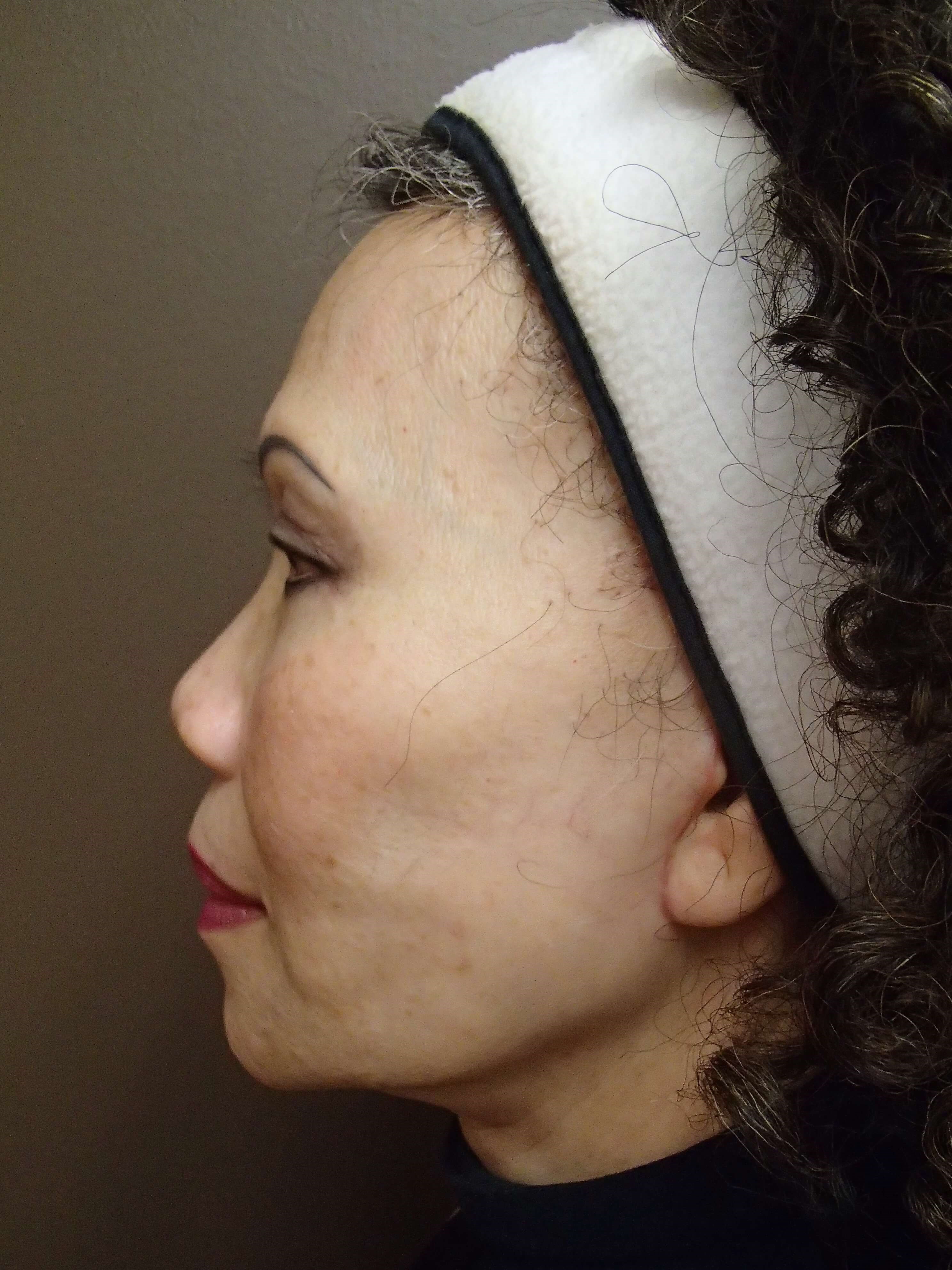 Facelift with Necklift After