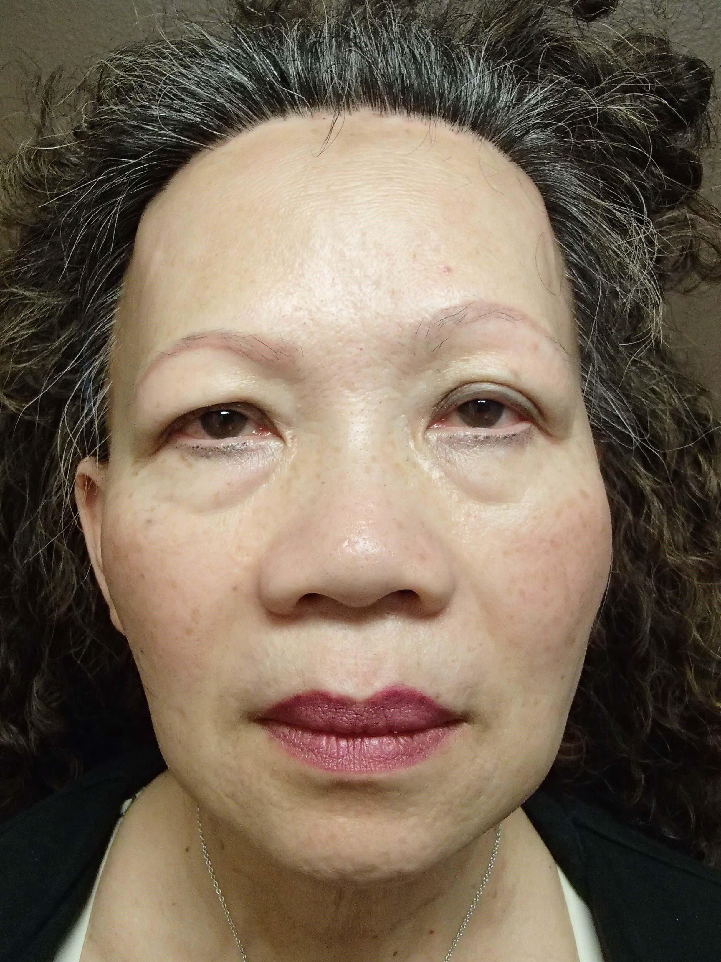Blepharoplasty Before
