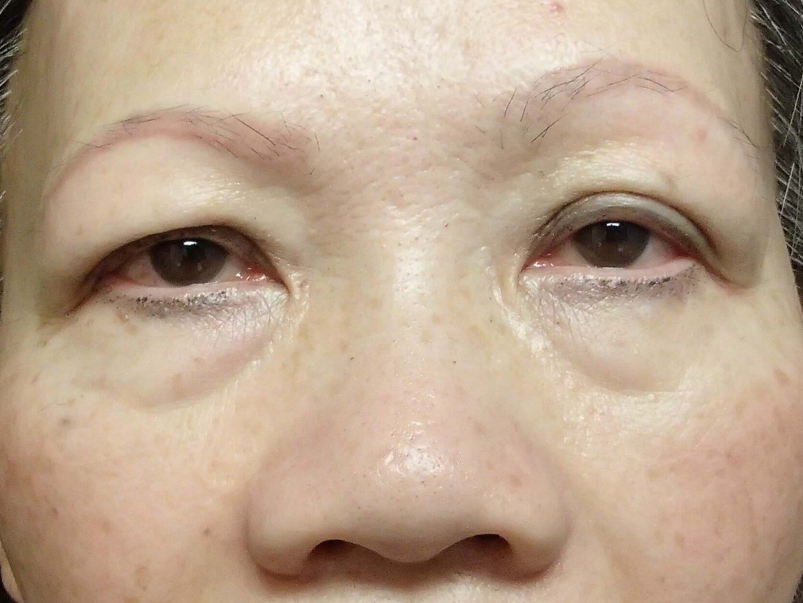 Blepharoplasty Before